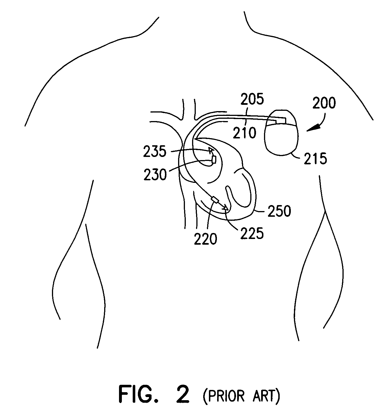 Implantable cardiac stimulator with electrode-tissue interface characterization