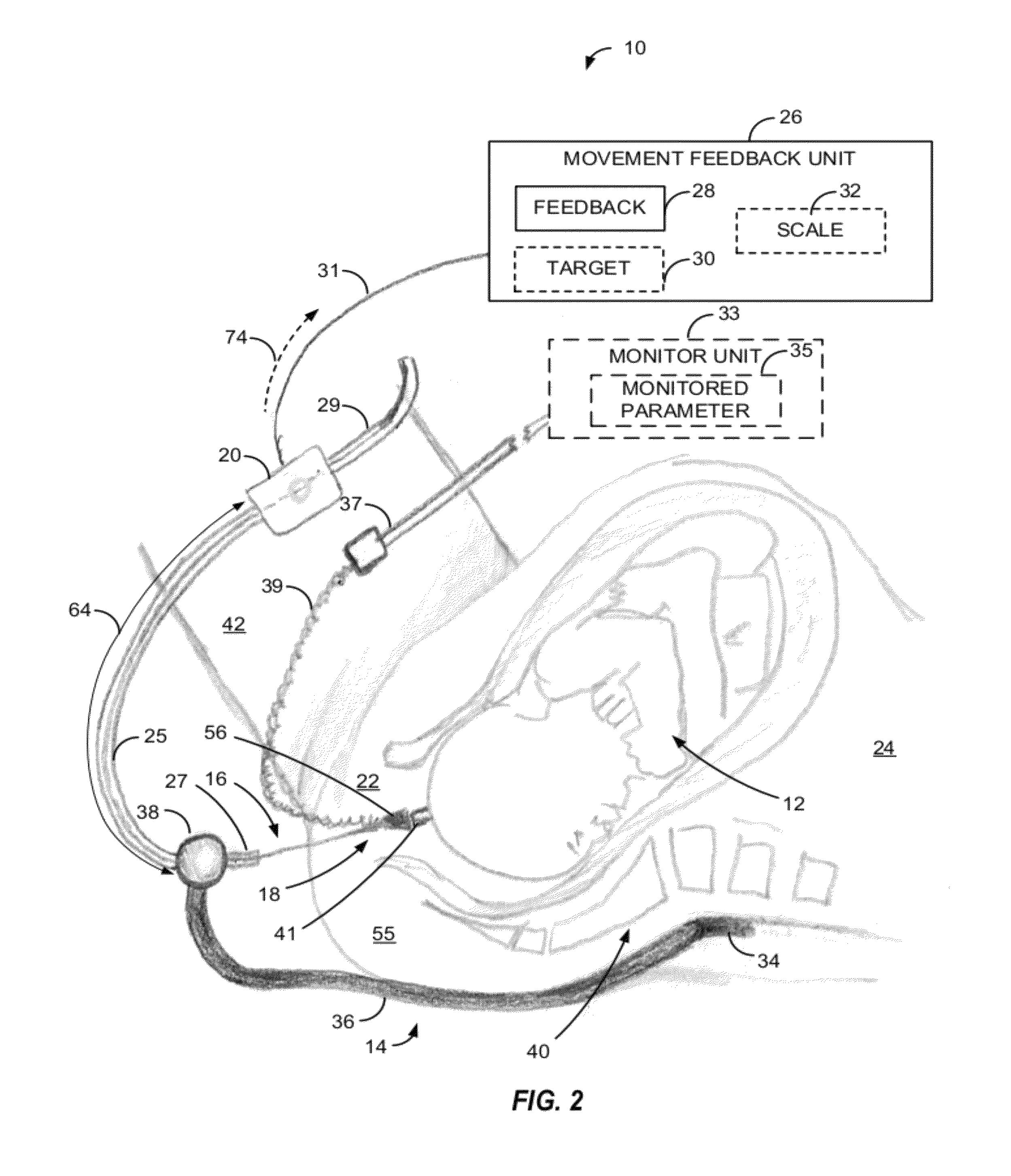 Apparatus and method of detecting movement of objects within the abdominal and/or pelvic region