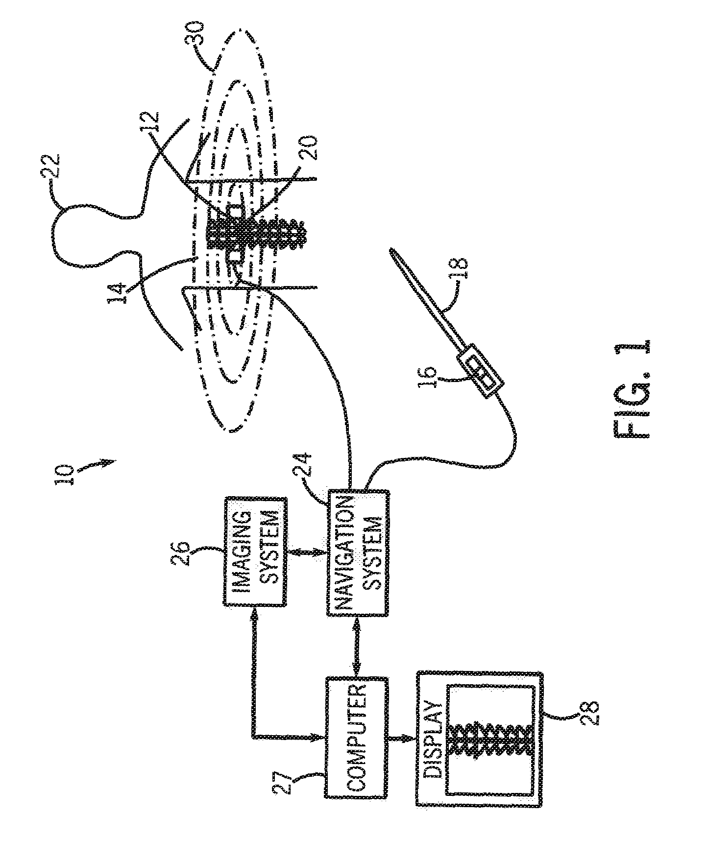 System and method for surgical navigation of motion preservation prosthesis