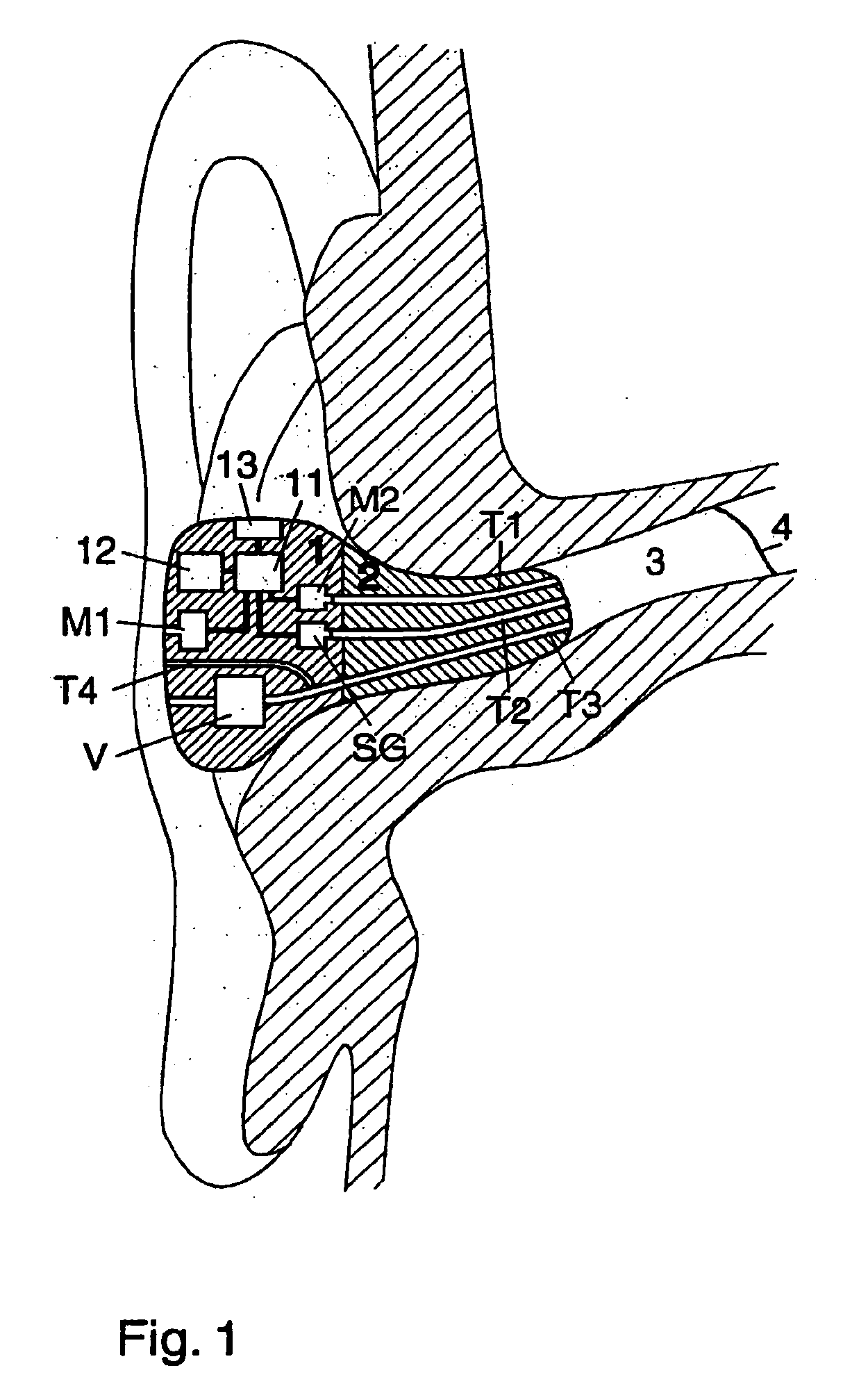 Ear terminal with microphone for voice pickup