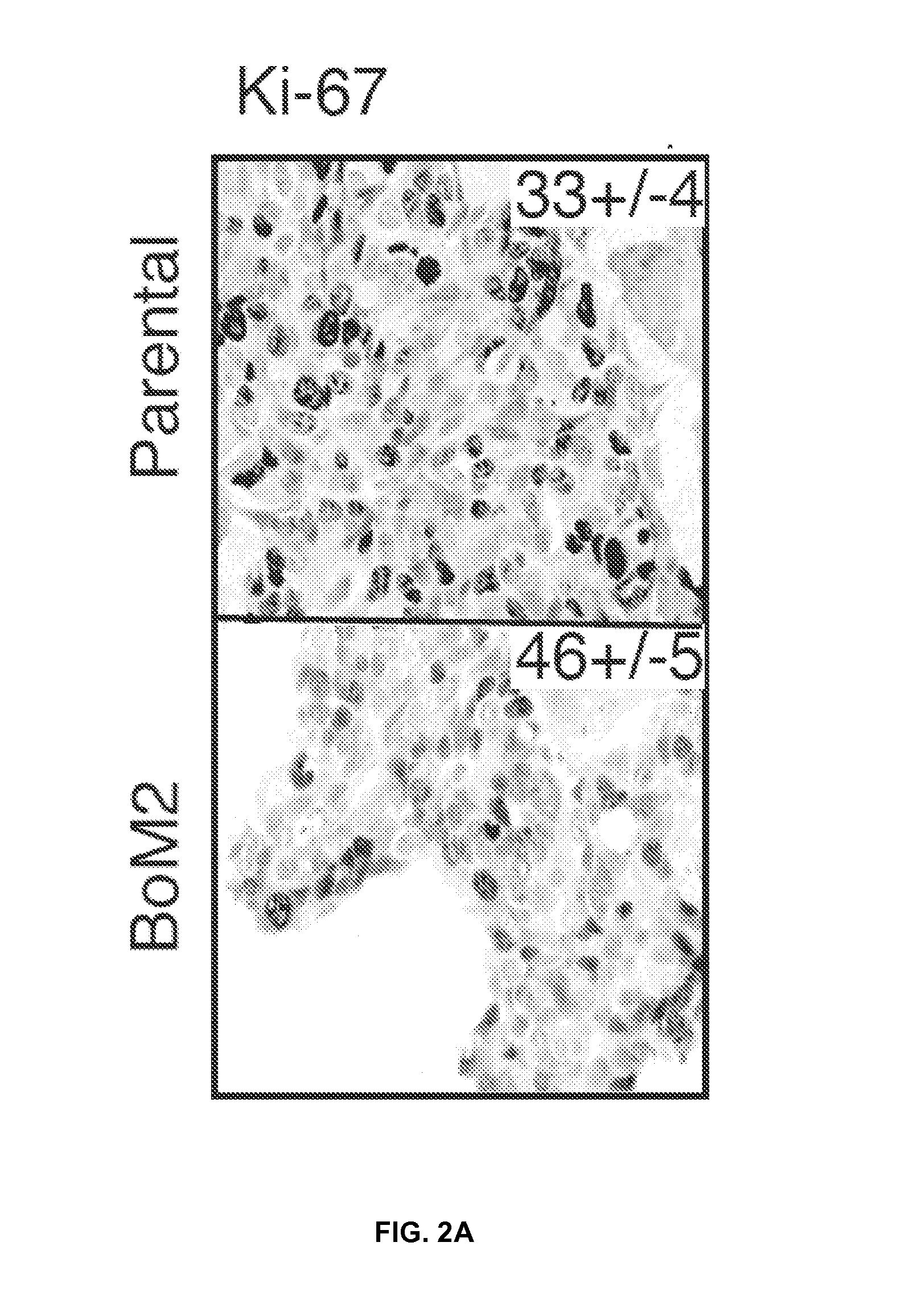Method for the diagnosis, prognosis, and tratment of cancer metastasis