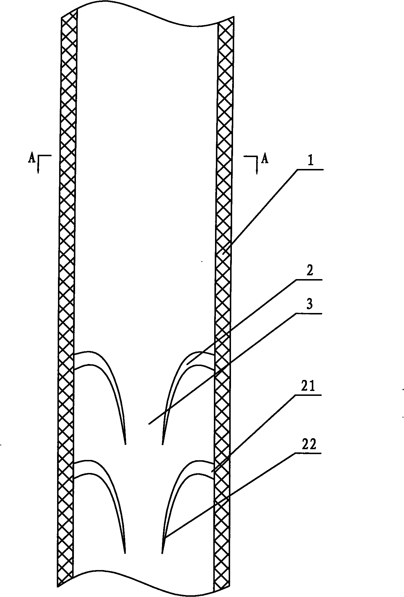 Anti-reflux support tube of ureter