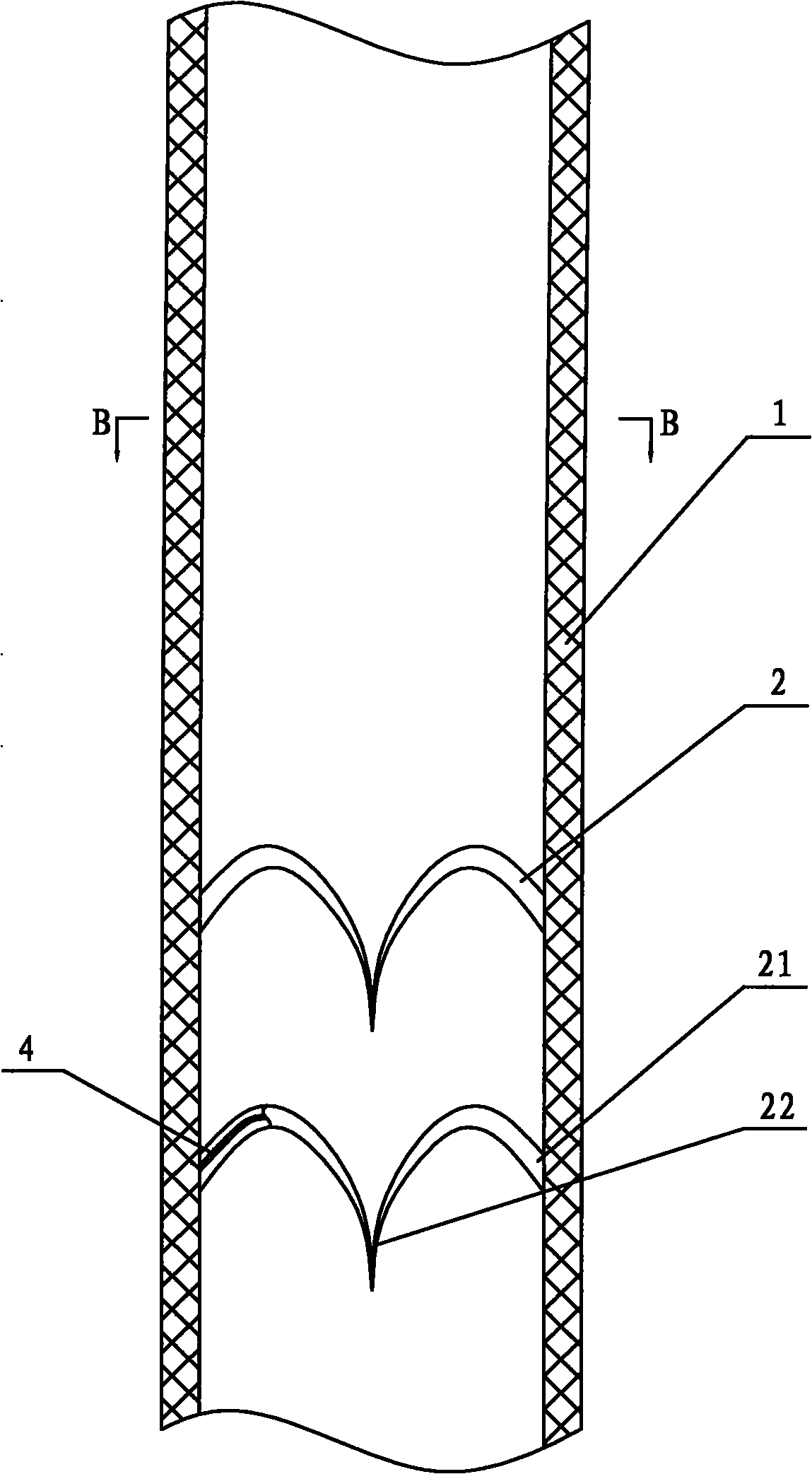 Anti-reflux support tube of ureter