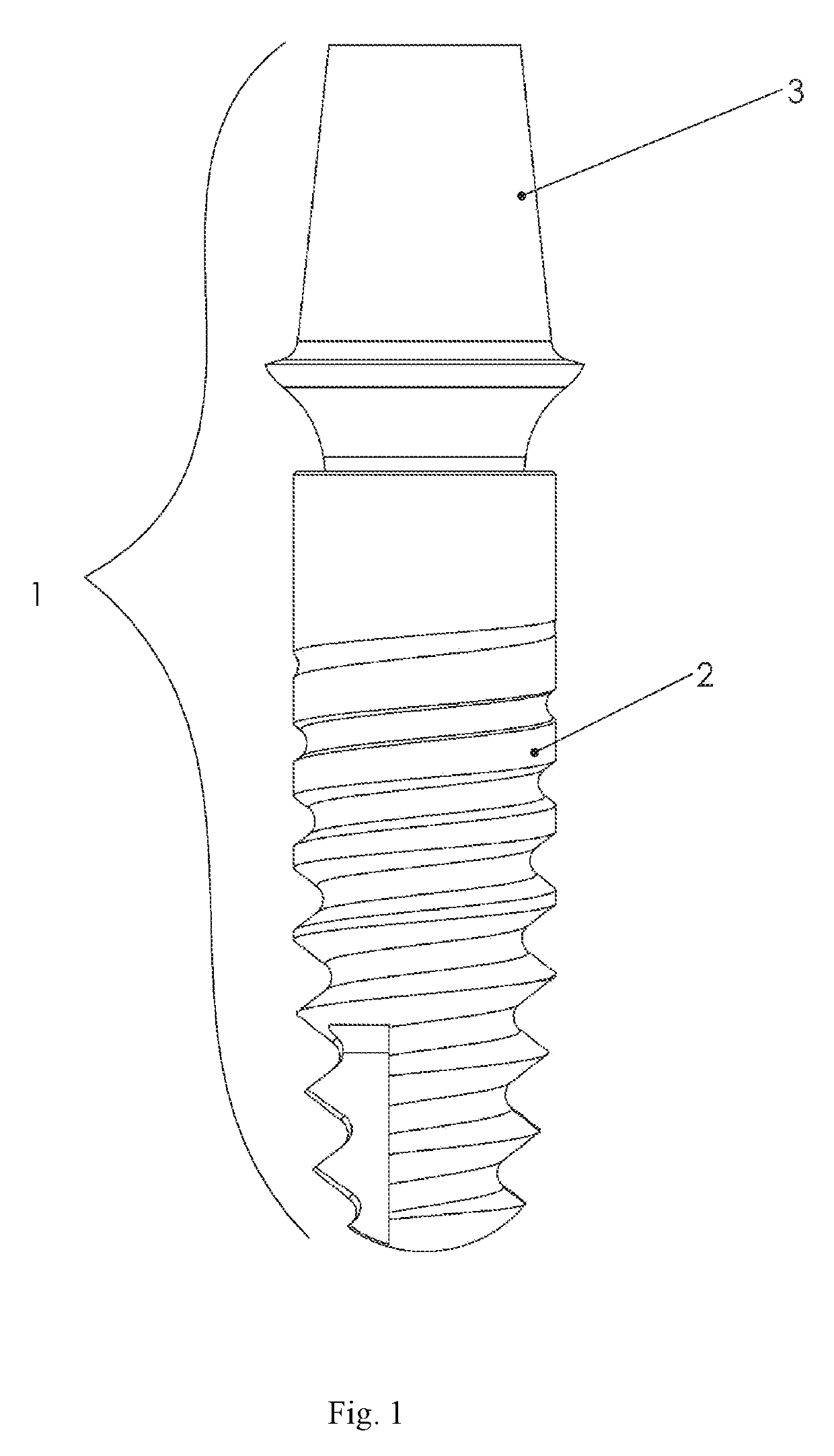 Dental implant