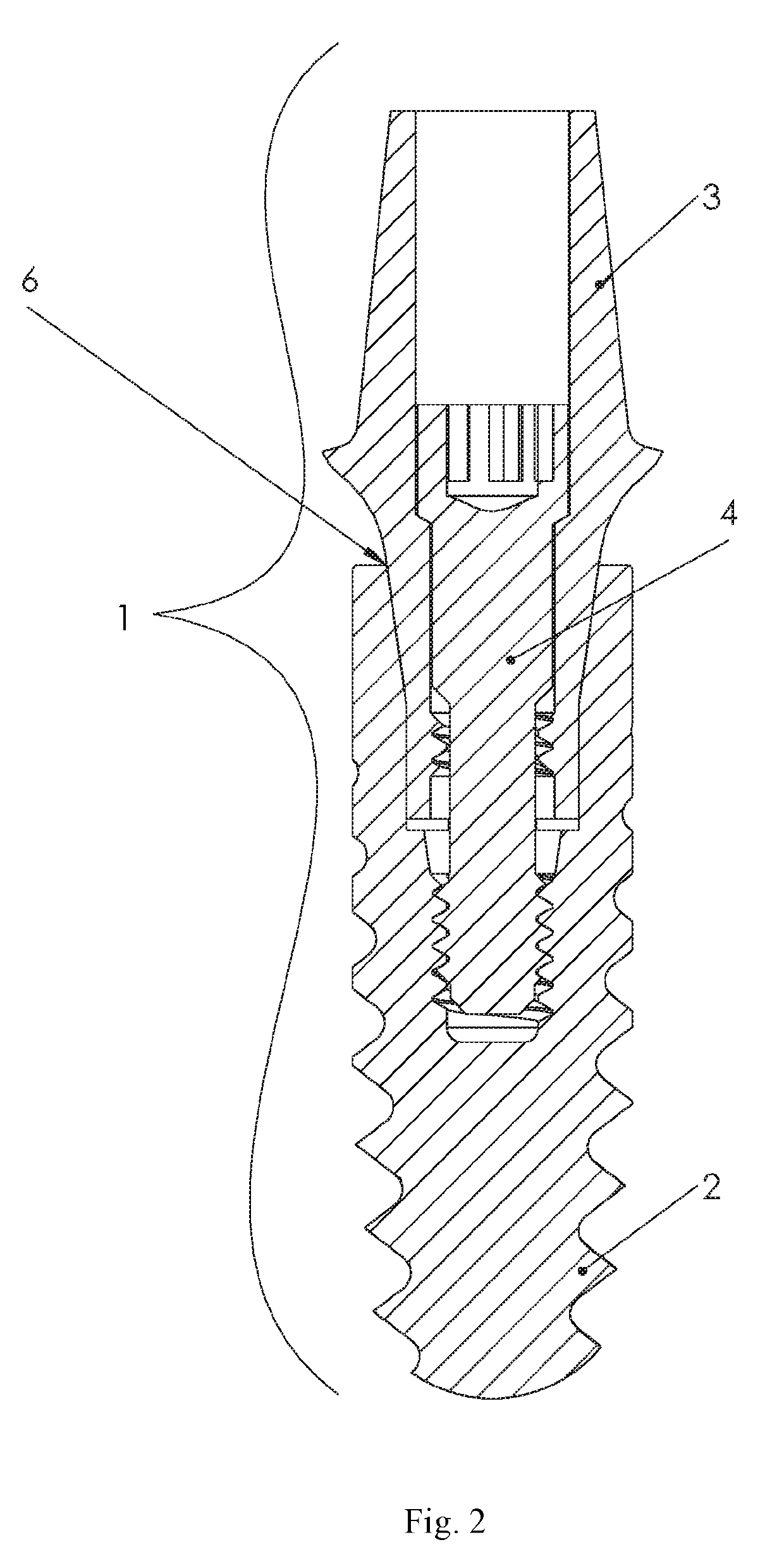 Dental implant