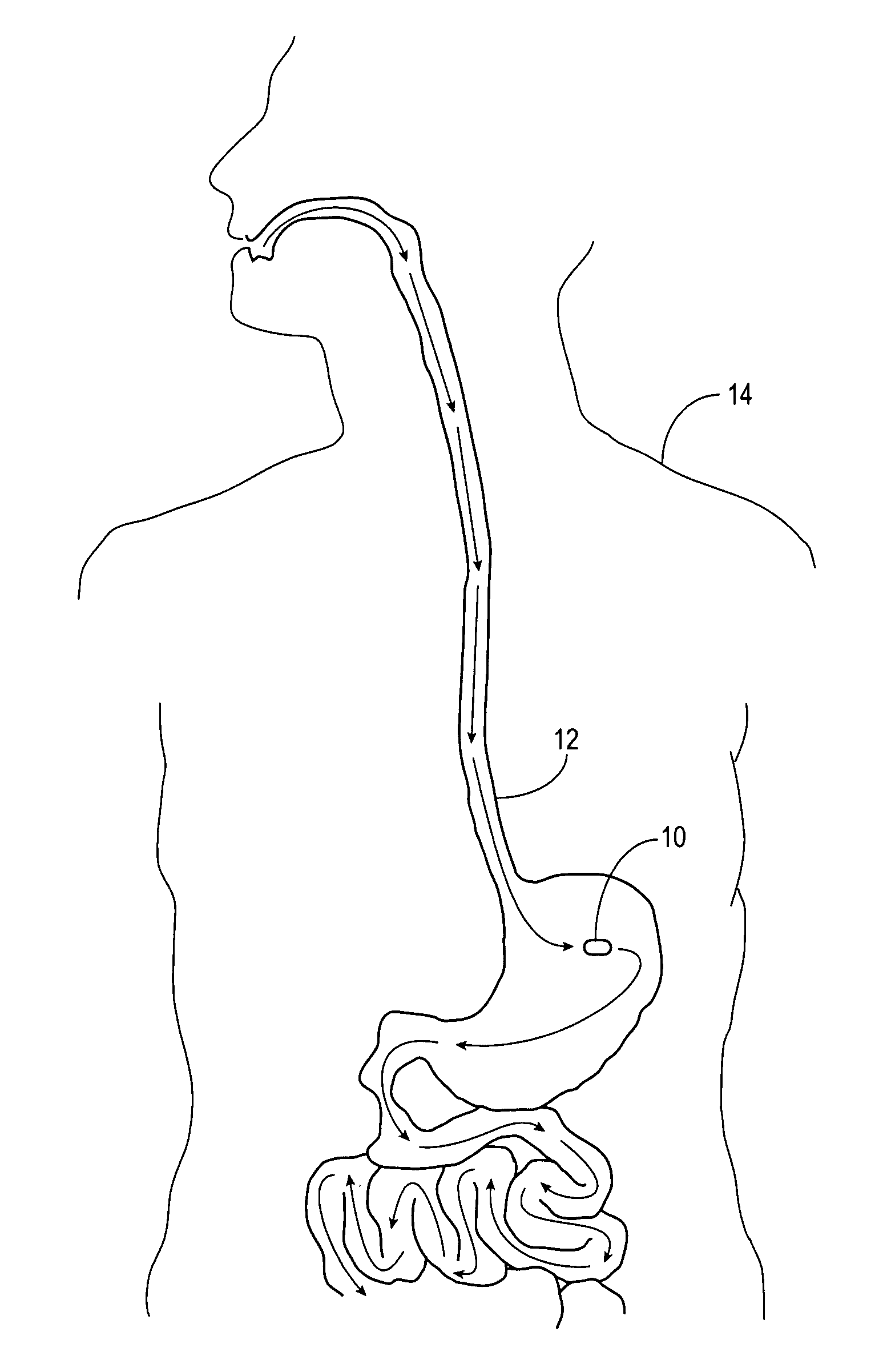 Method of using a gastrointestinal stimulator device for digestive and eating disorders