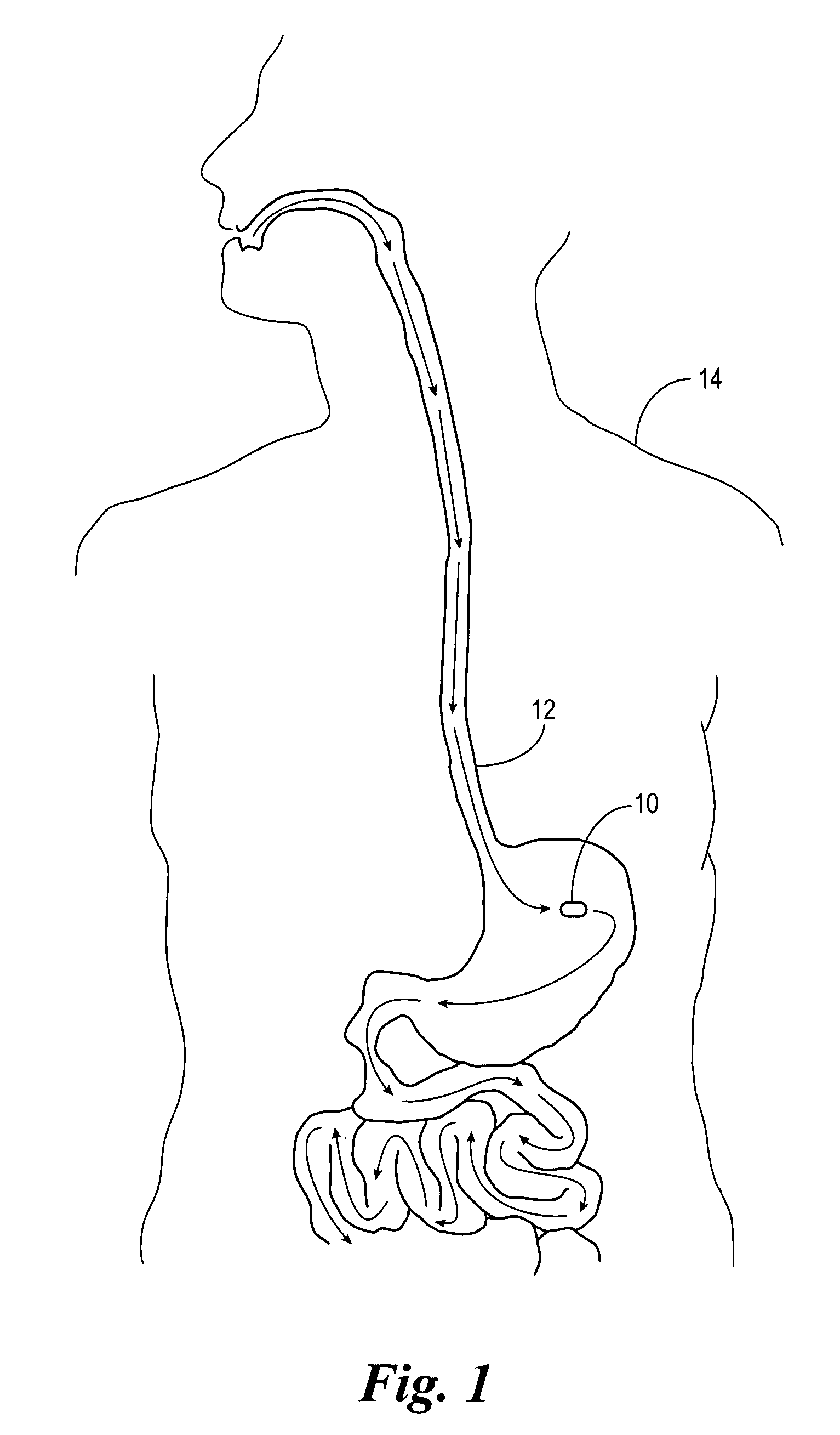 Method of using a gastrointestinal stimulator device for digestive and eating disorders