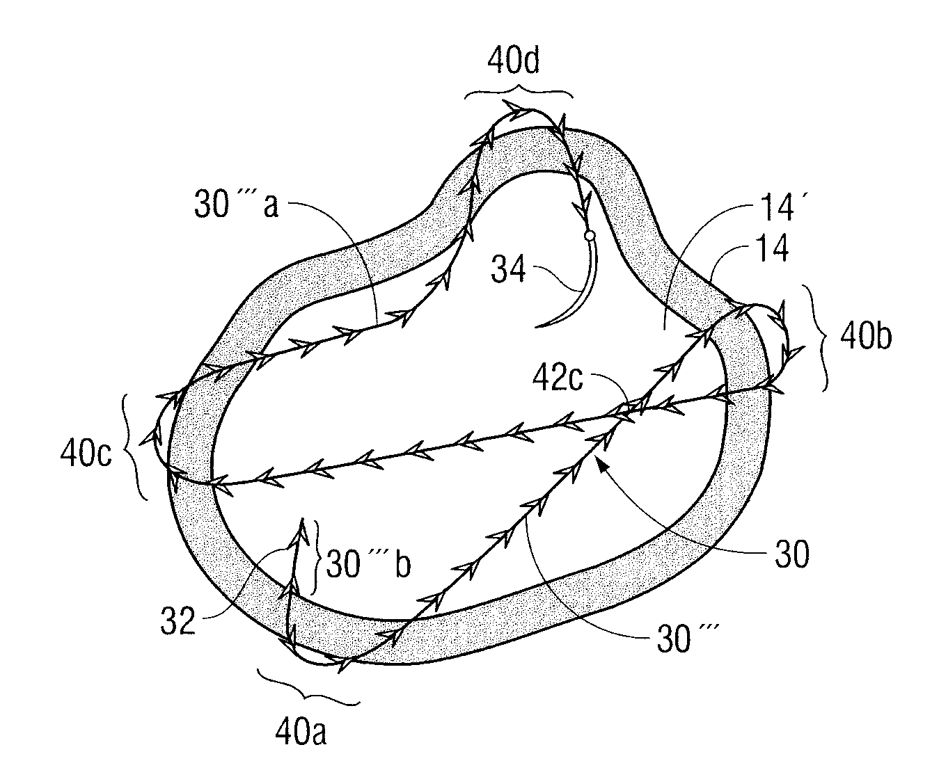 Method Of Using Barbed Sutures For Gastric Volume Reduction