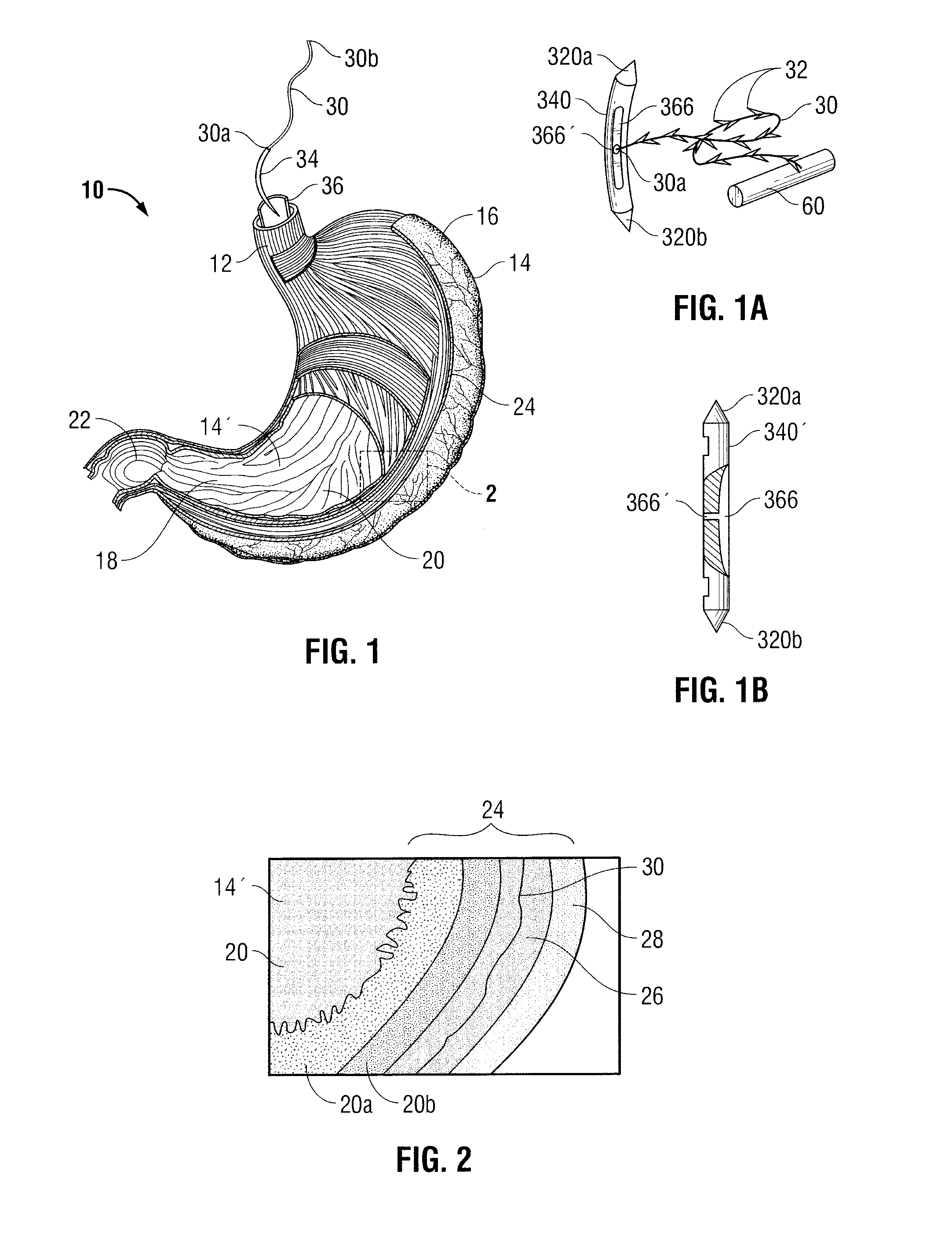 Method Of Using Barbed Sutures For Gastric Volume Reduction