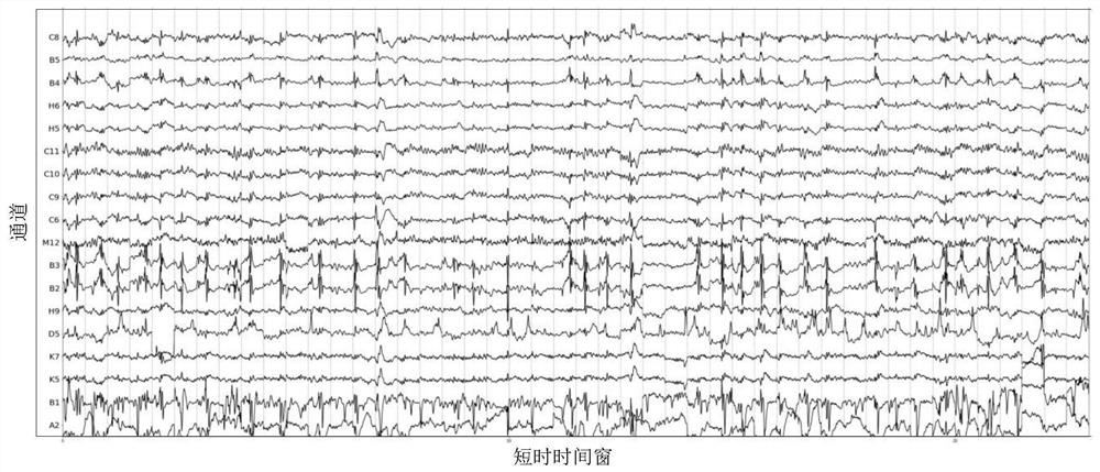 Data extraction method for epilepsy abnormal group activities in interval intracranial electroencephalogram signals