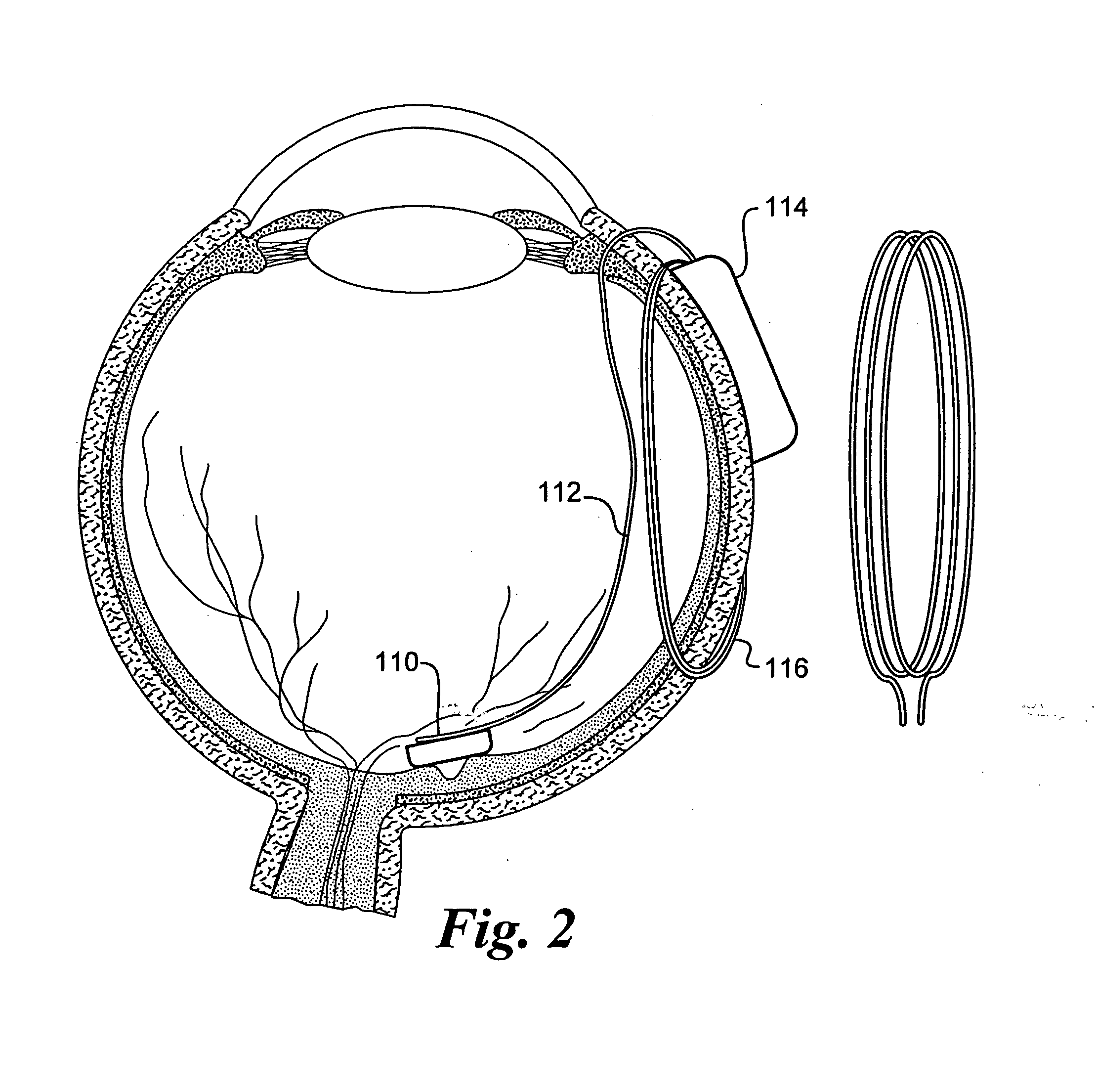 Retinal prosthesis