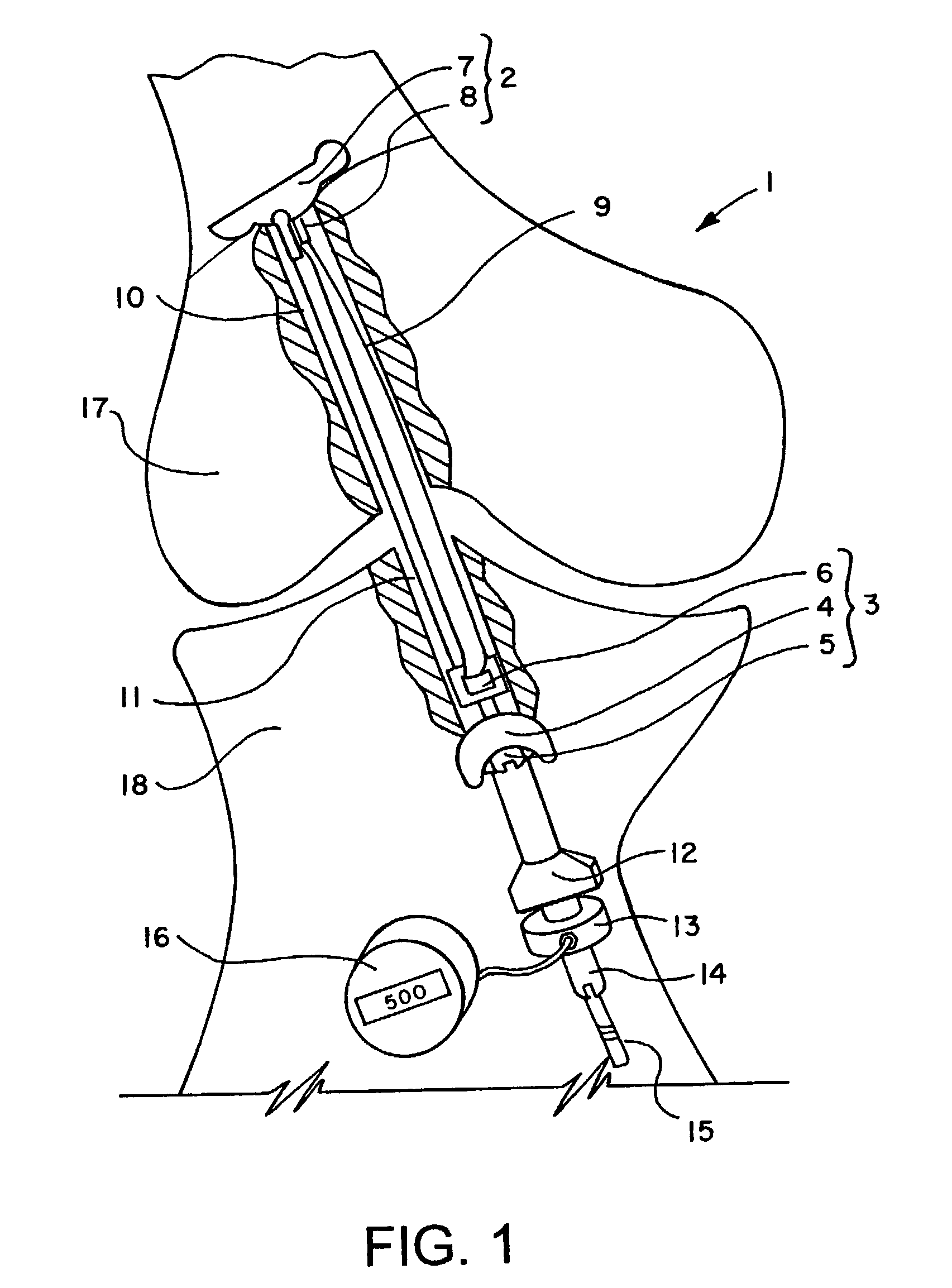 Flip-wing tissue retainer