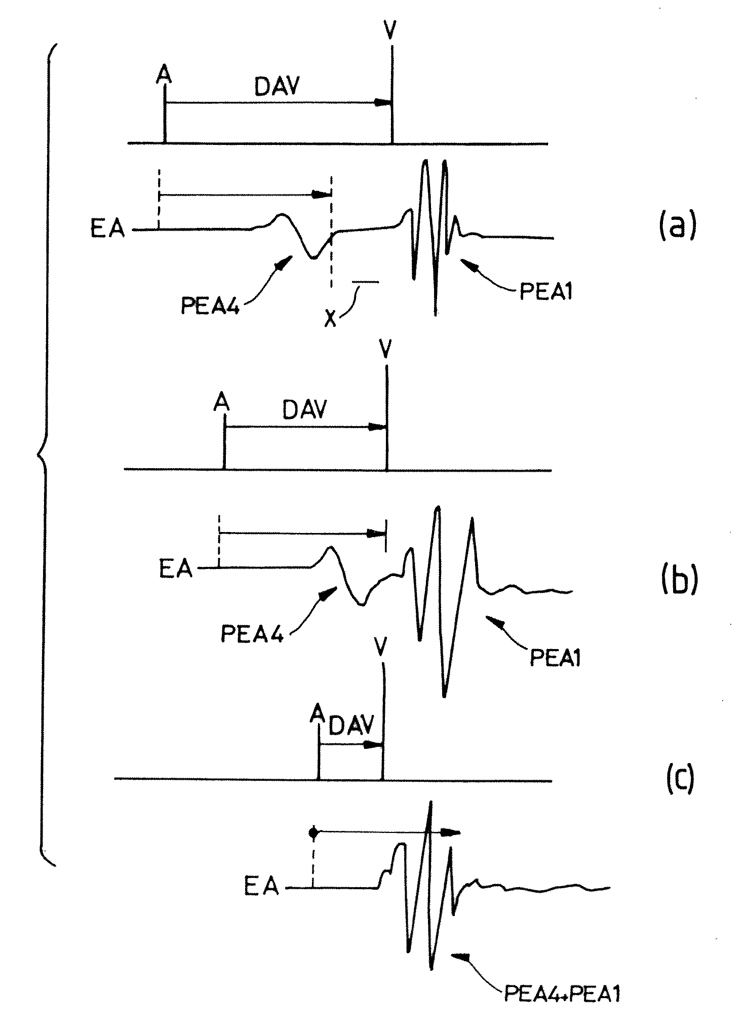 Calculation of the Atrioventricular Delay for an Active Implantable Metal Device