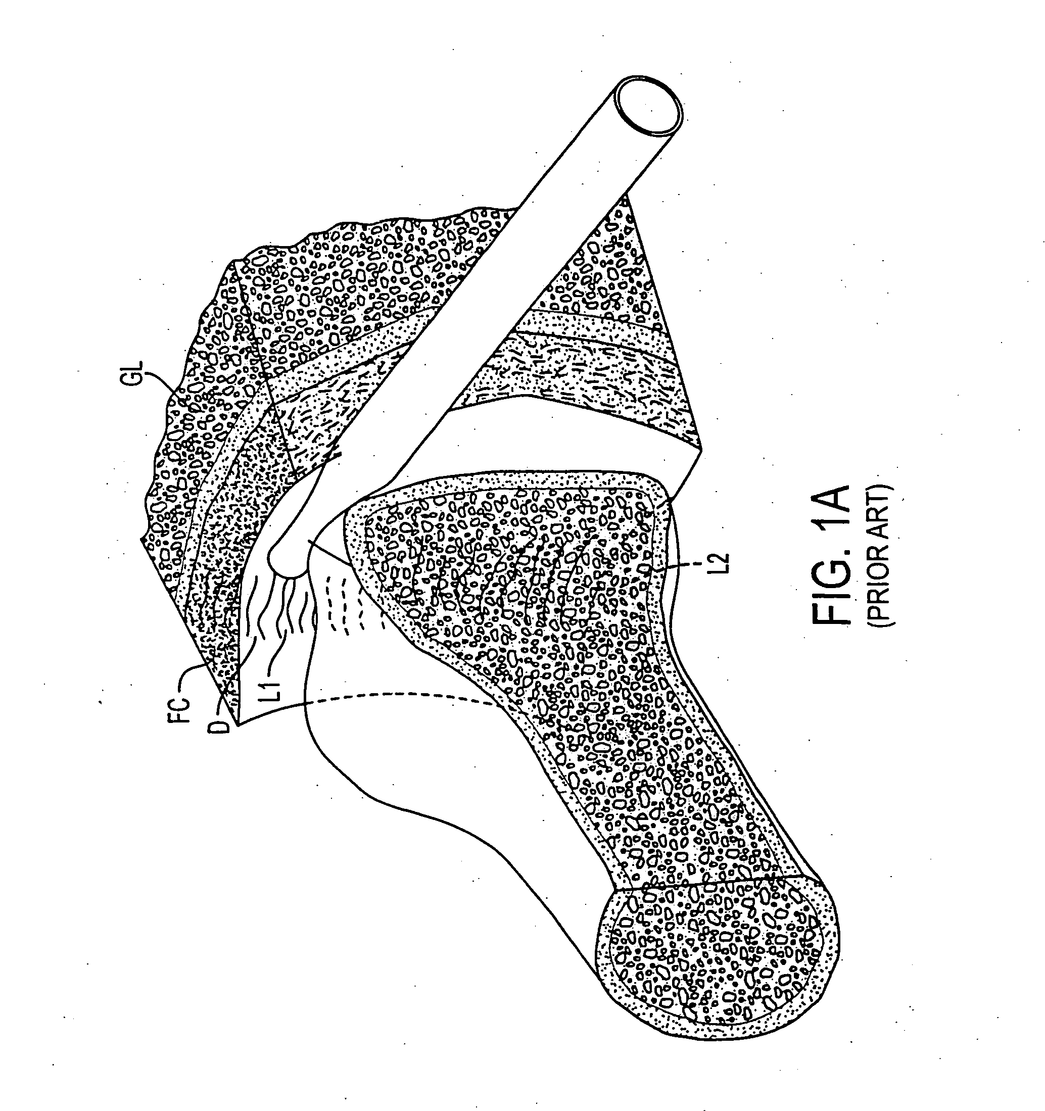 RF electrode array for low-rate collagen shrinkage in capsular shift procedures and methods of use