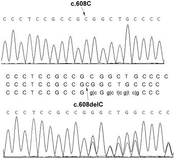 CC (congenital cataract) PITX3 gene novel mutation