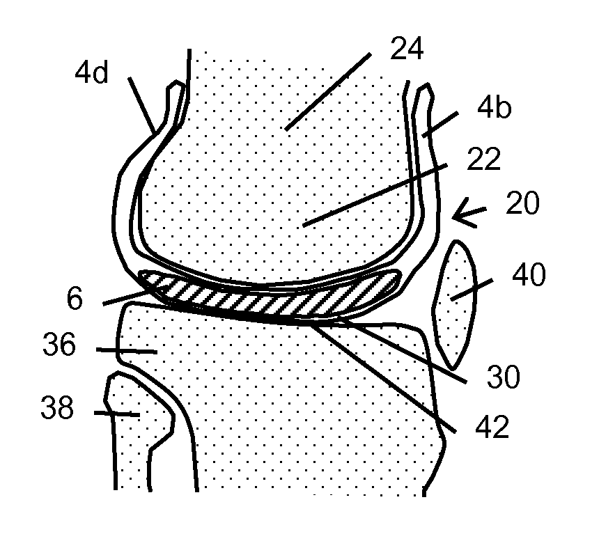 Resilient knee implant and methods