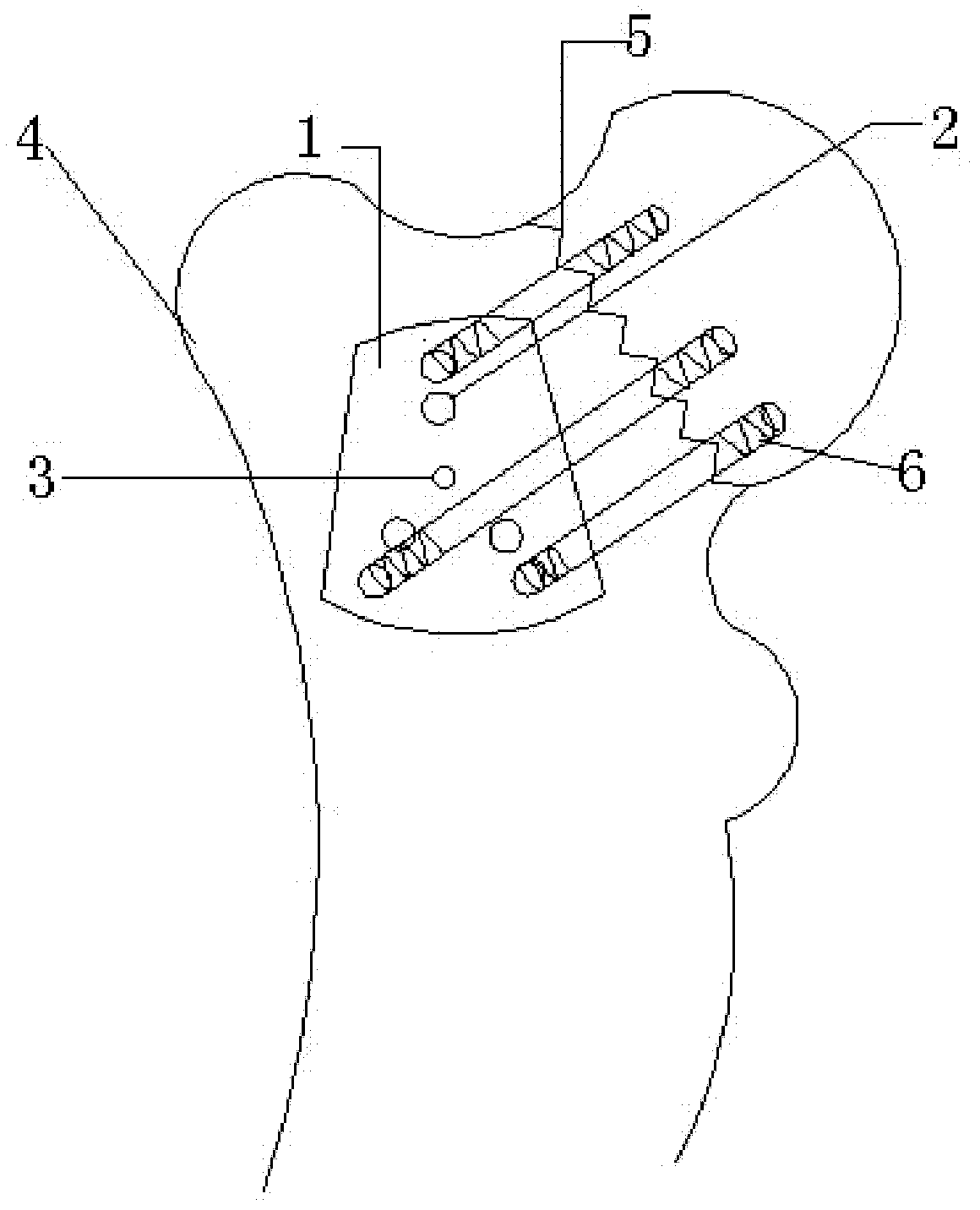 Trapezoid locking steel plate with radifor treating femoral neck fracture