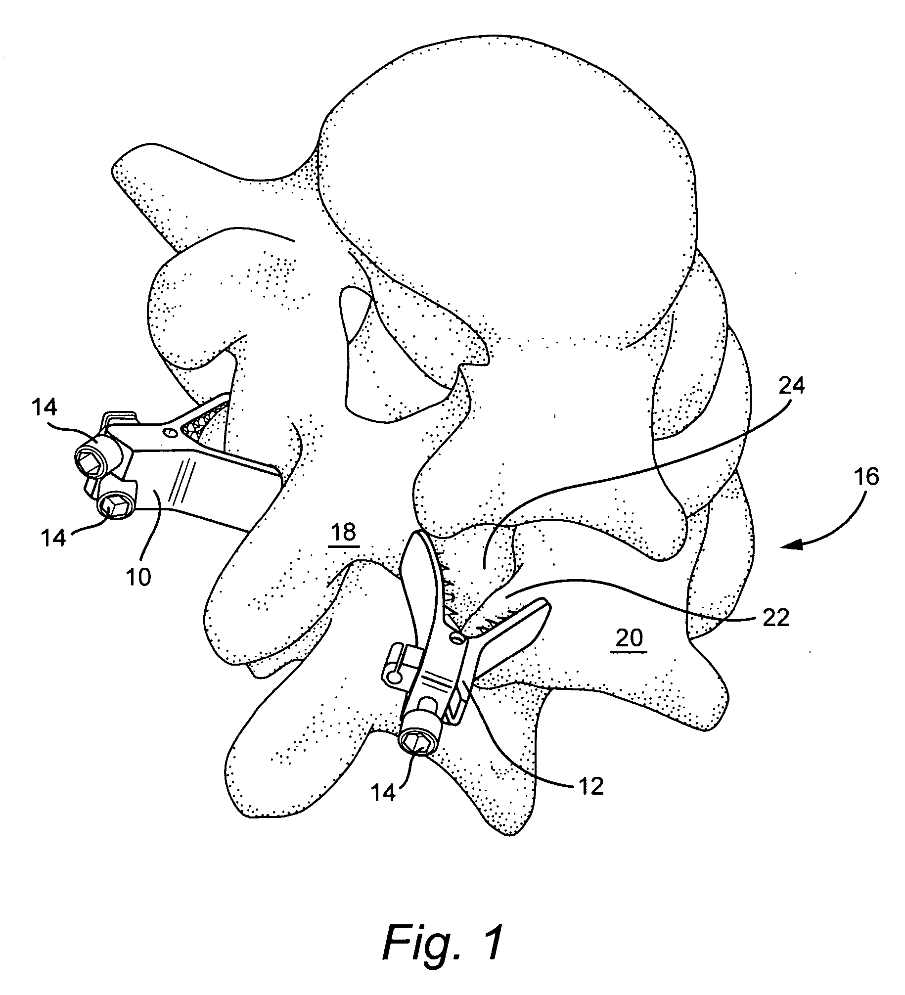 Clamping system and method for fusing vertebral elements in a spine