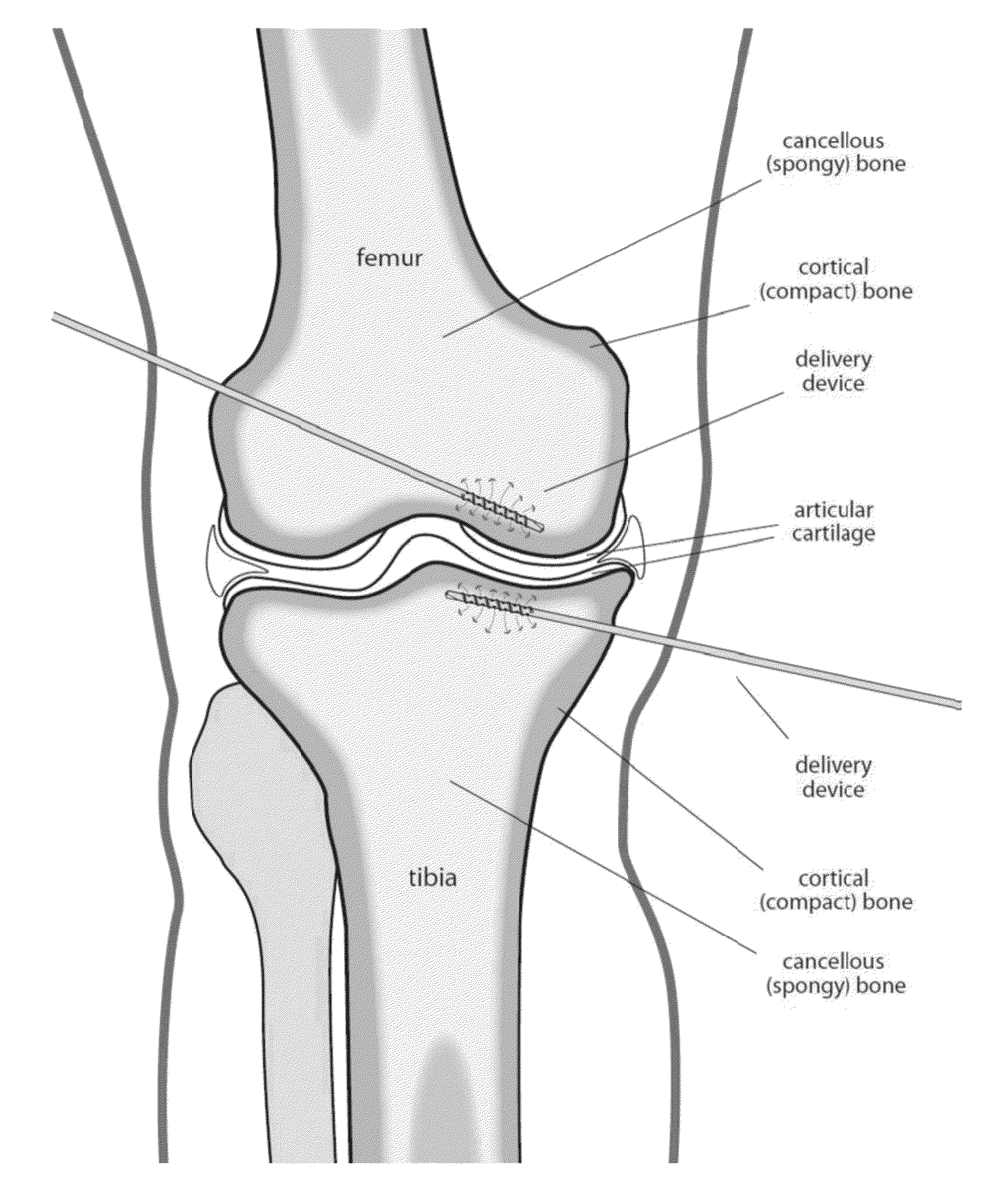 Cartilage repair, preservation and growth by stimulation of bone-chondral interfase and delivery system and methods therefor