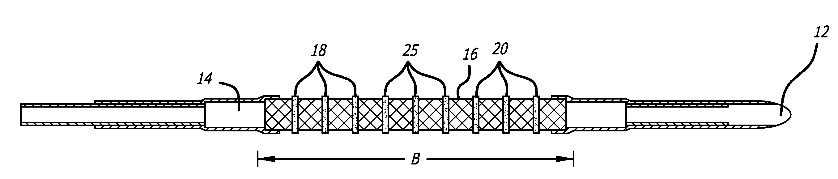 Tethered Self-Expanding Stent Delivery System