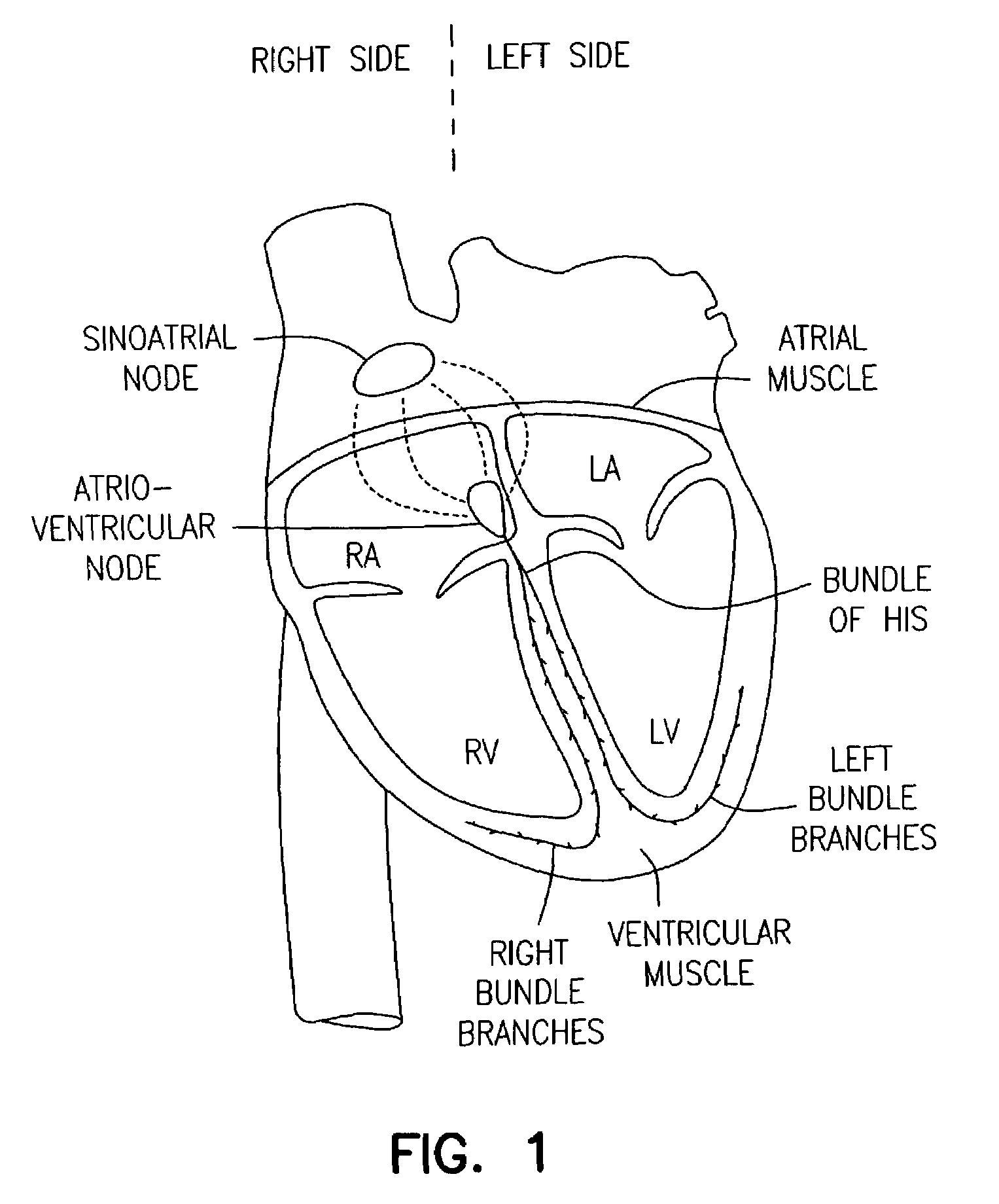 Method and apparatus for optimizing ventricular synchrony during DDD resynchronization therapy using adjustable atrio-ventricular delays