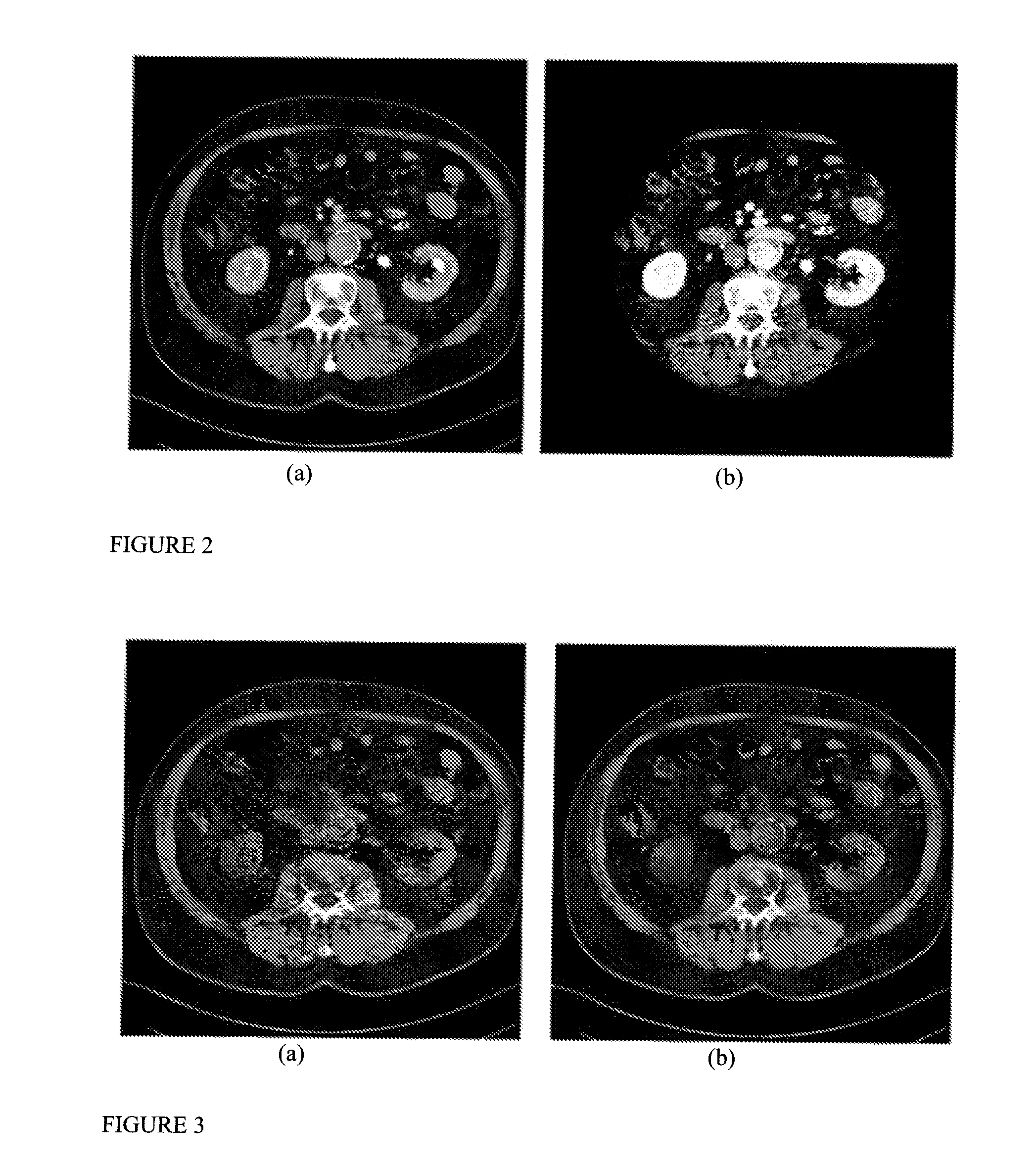 System and method for multi-image based virtual non-contrast image enhancement for dual source ct