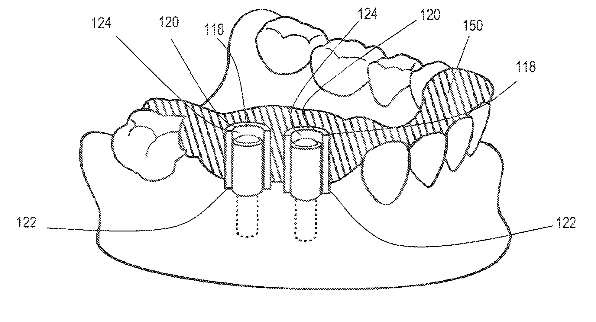 Method for making and using a template for locating a dental implant and components relating thereto