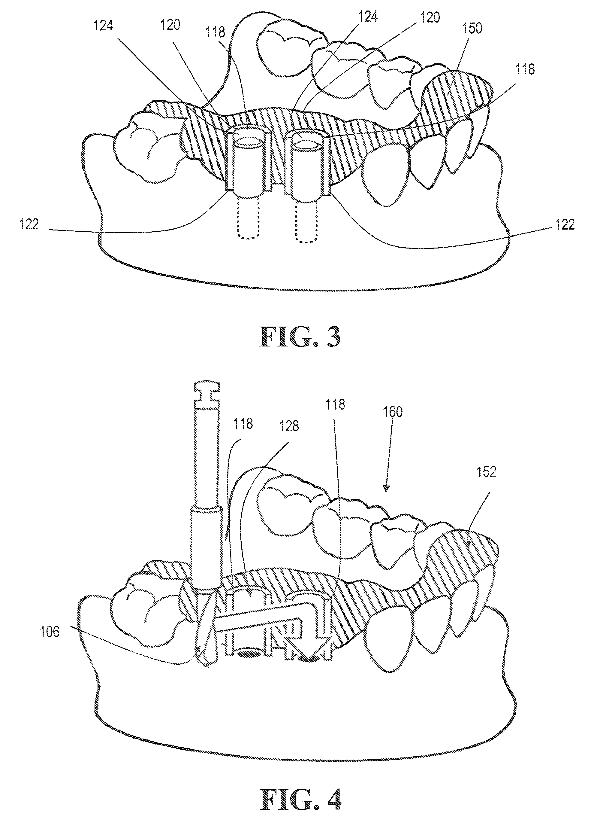 Method for making and using a template for locating a dental implant and components relating thereto