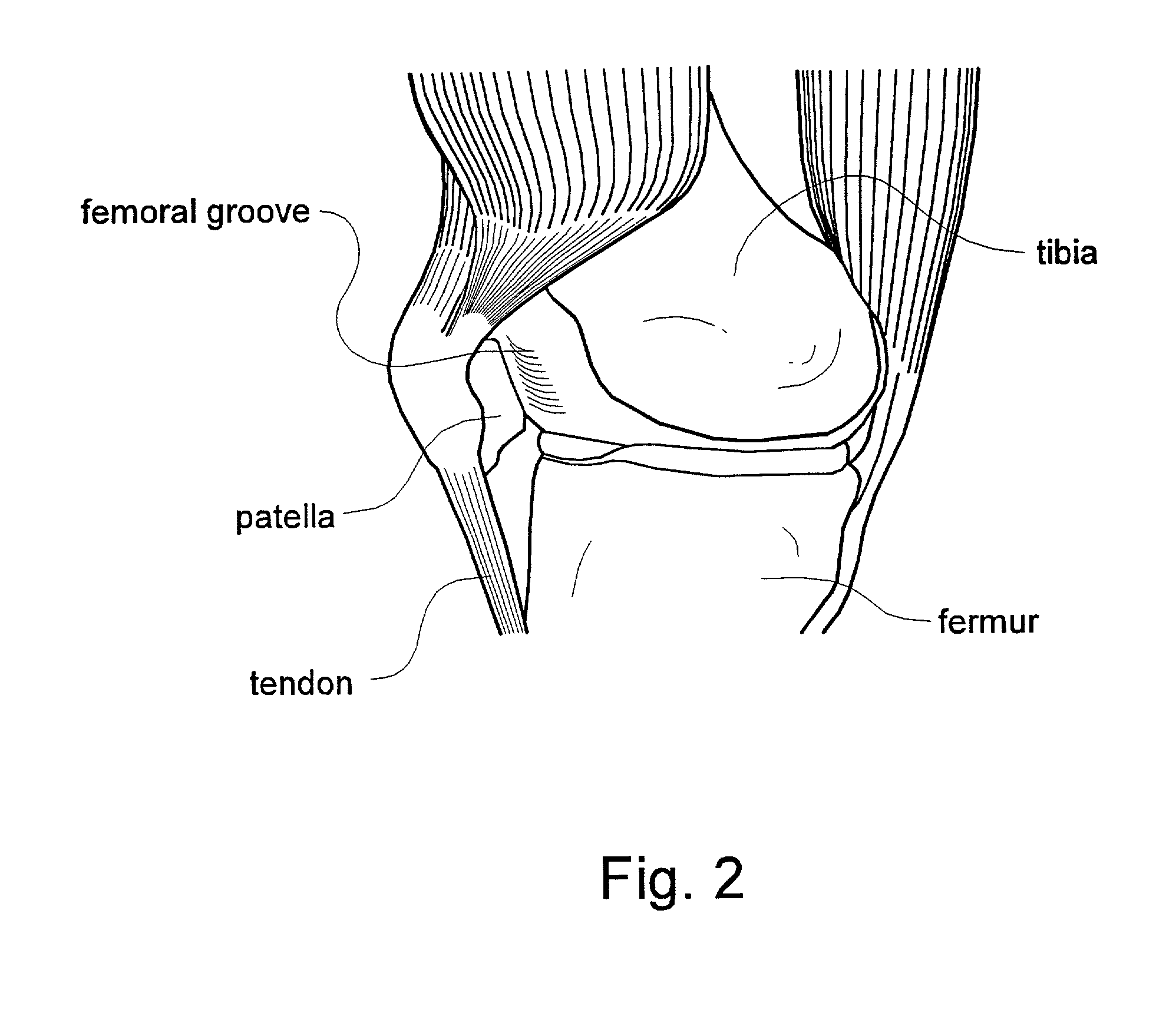 Custom-moldable patellar support, support product for improved patella tracking, and method