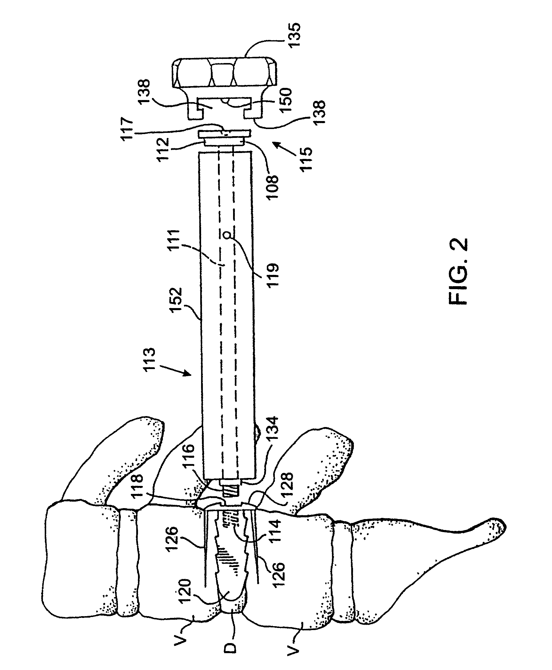Apparatus and method of inserting spinal implants