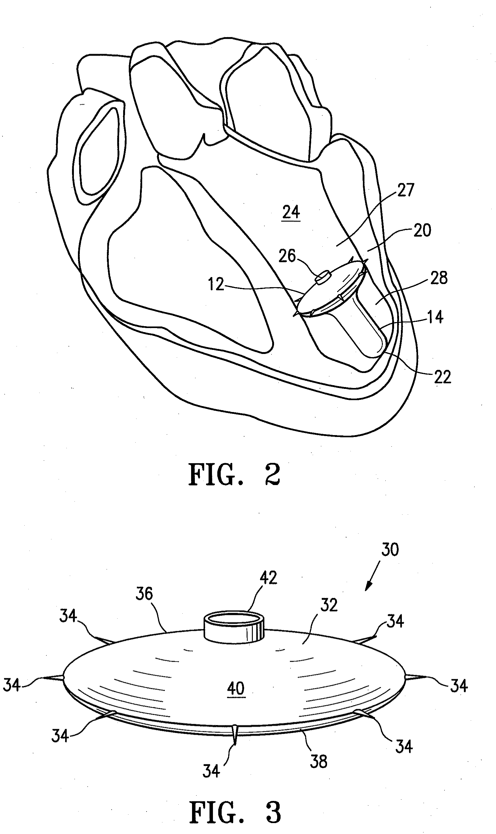 Inflatable ventricular partitioning device