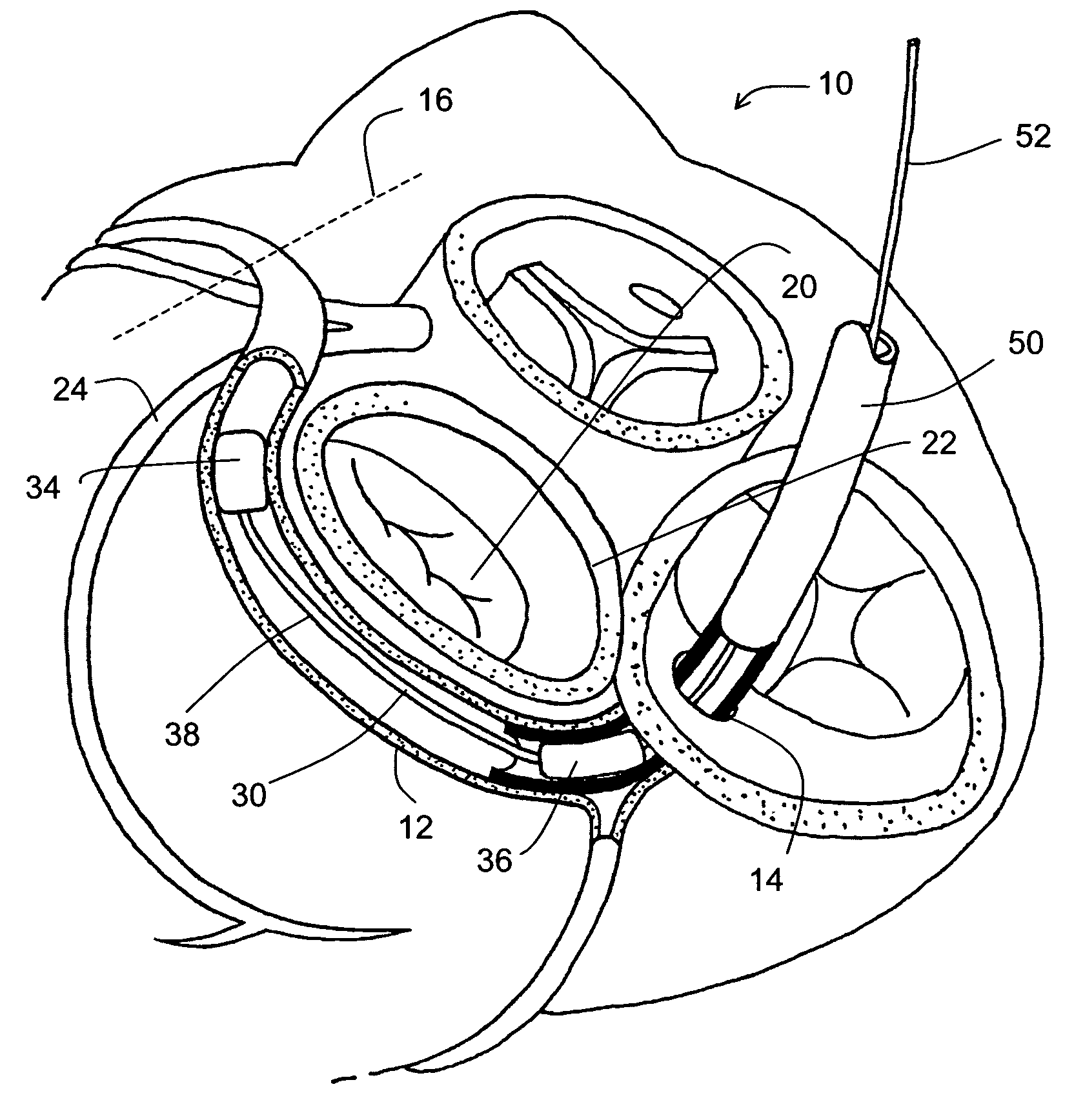 Reduced length tissue shaping device