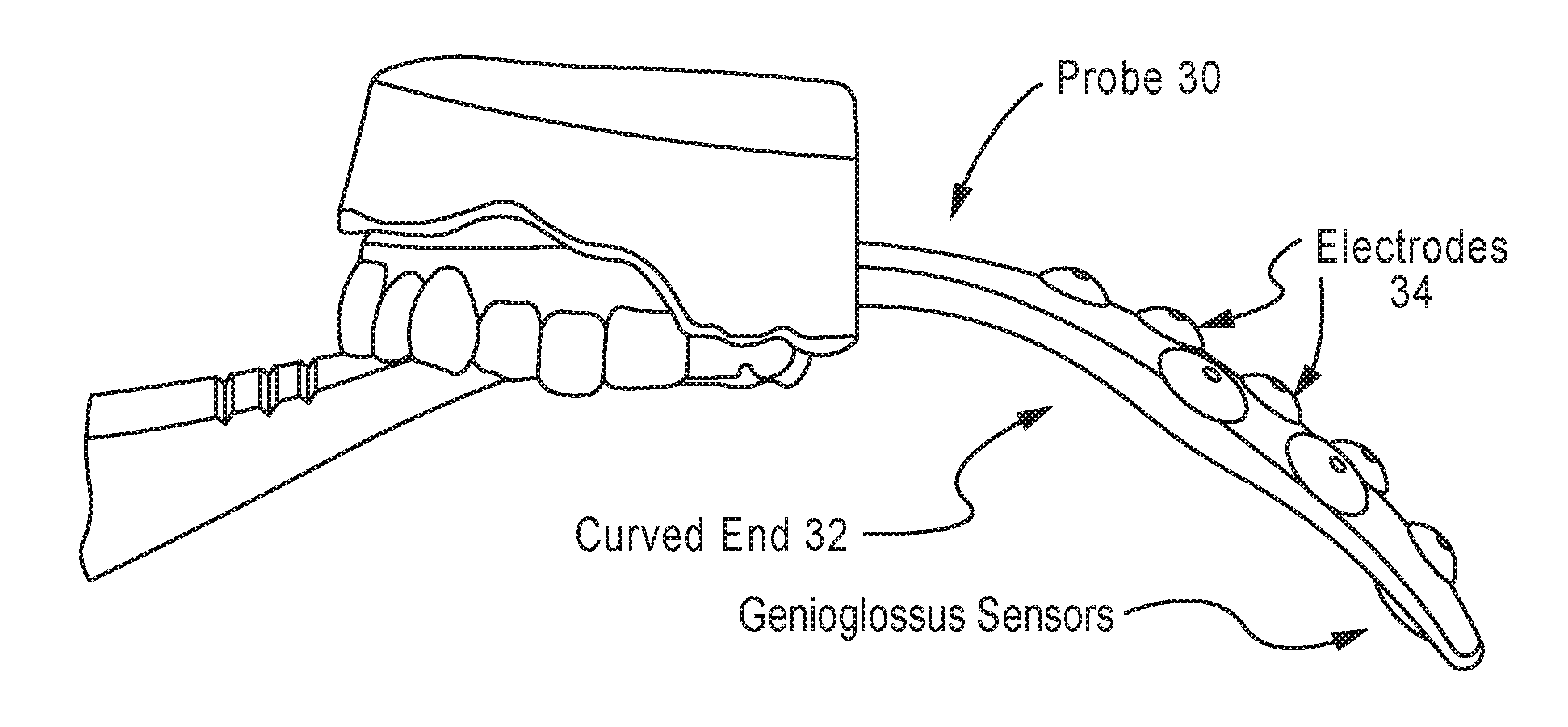 Systems, methods and devices for sensing emg activity