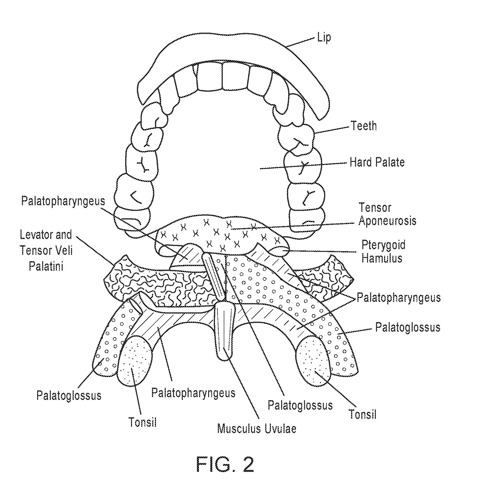 Systems, methods and devices for sensing emg activity