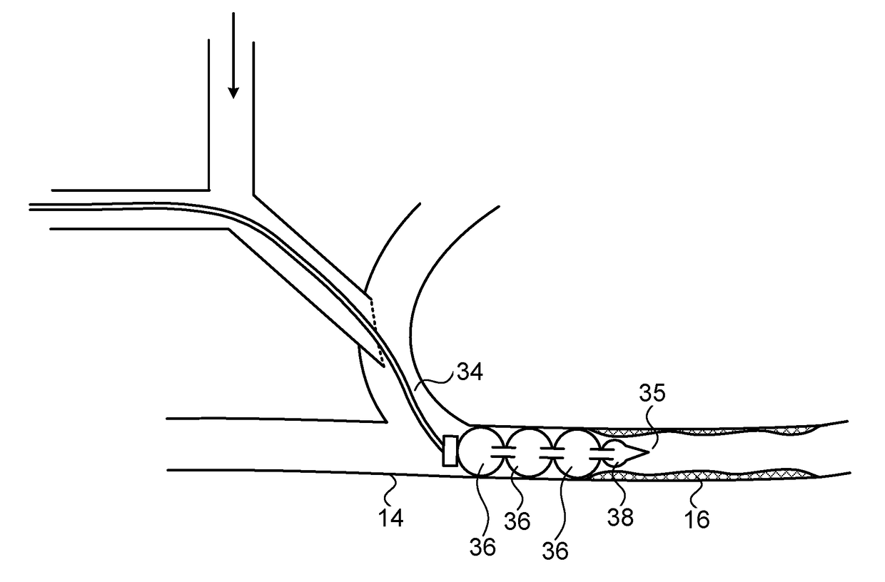 Device for prevention of shunt stenosis