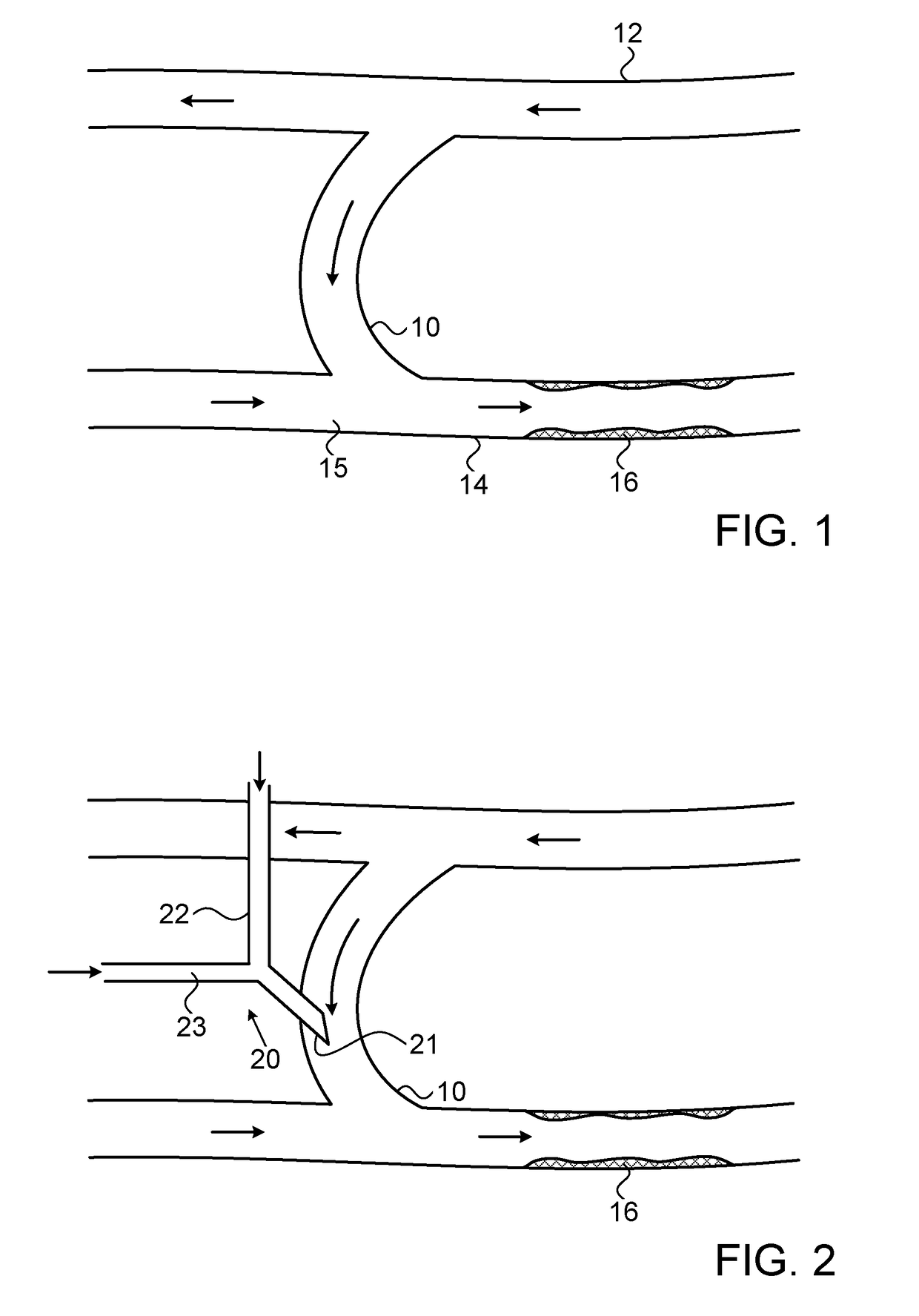 Device for prevention of shunt stenosis