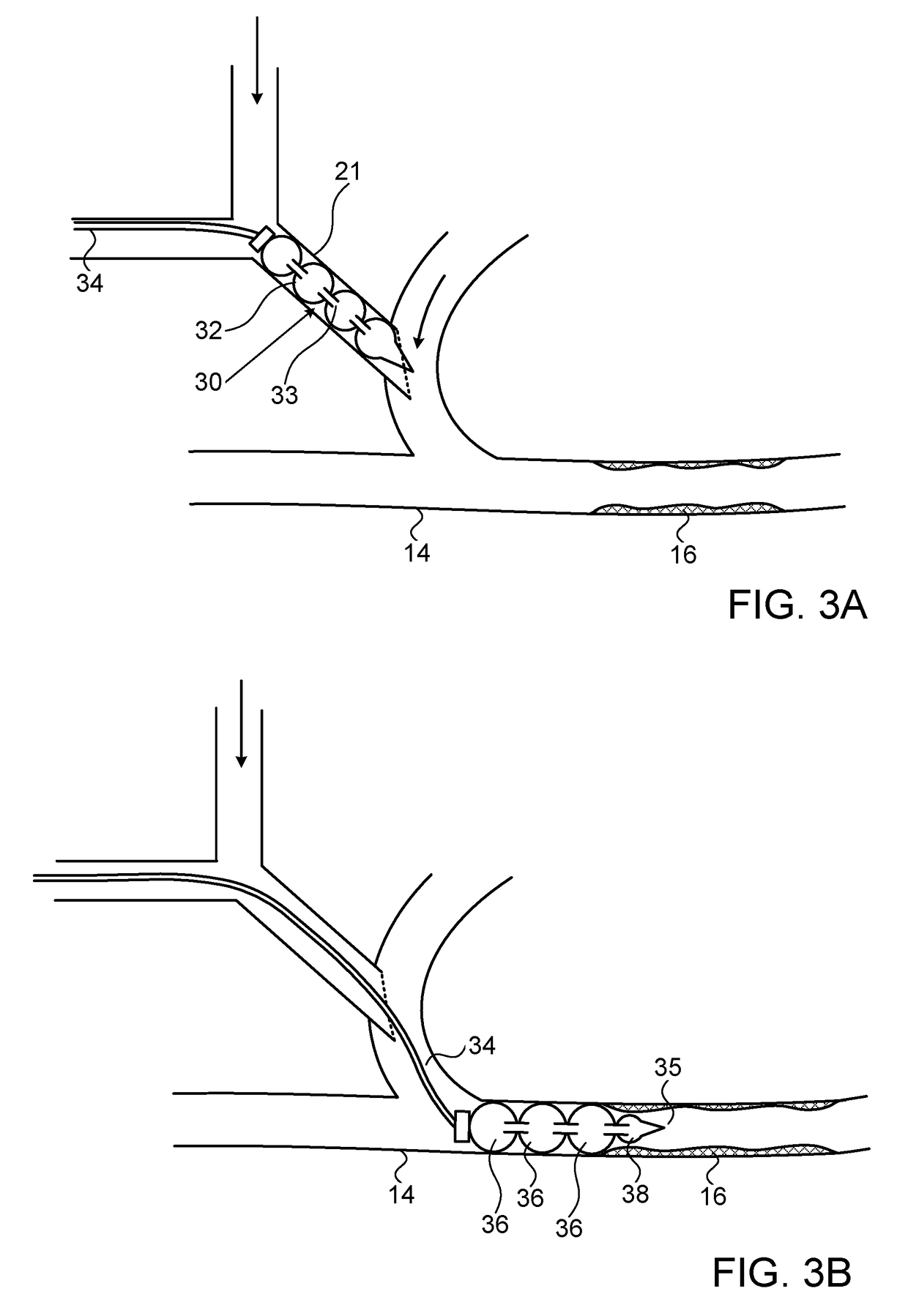 Device for prevention of shunt stenosis