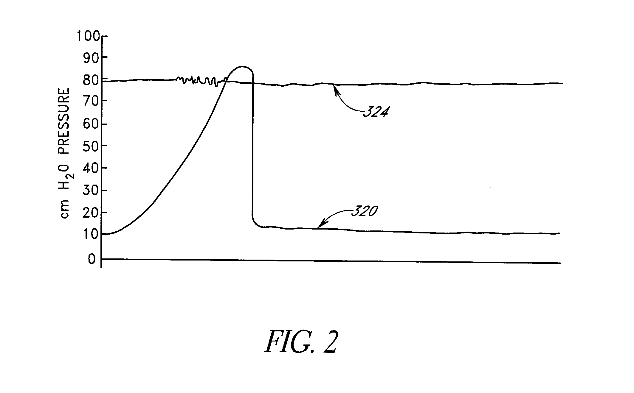 Attenuation device for treating glaucoma