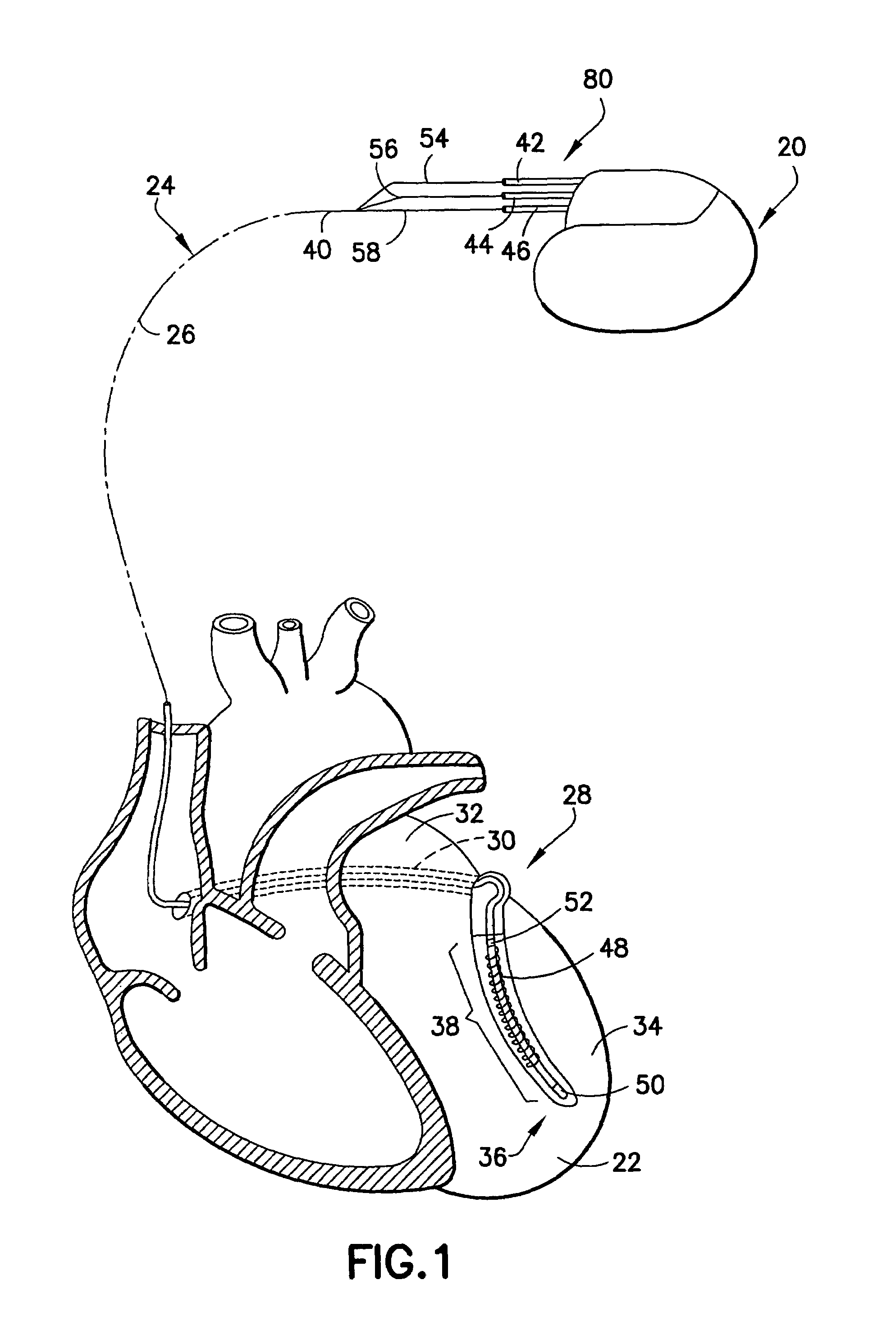 Super plastic design for CHF pacemaker lead