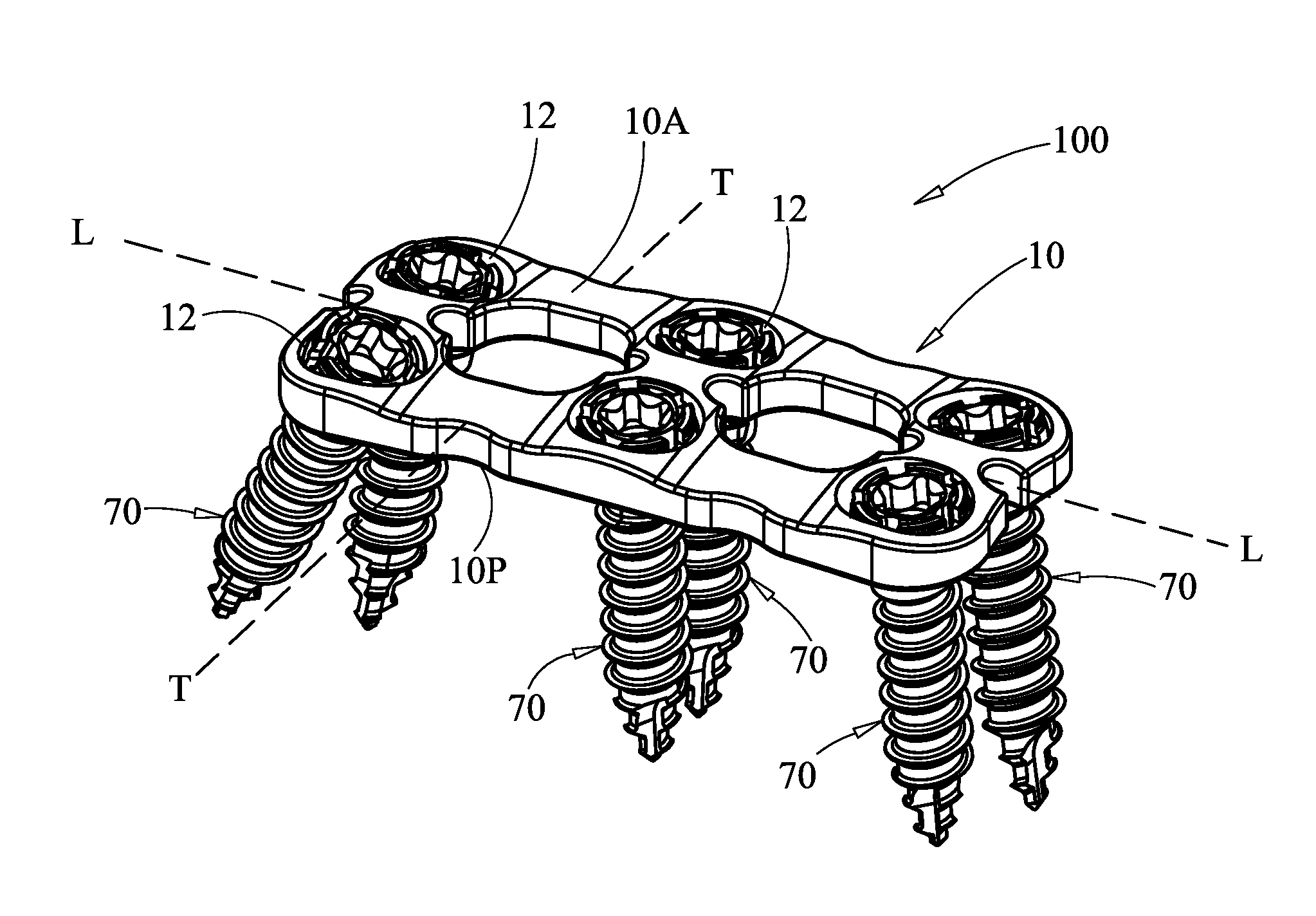 Surgical plate system and method