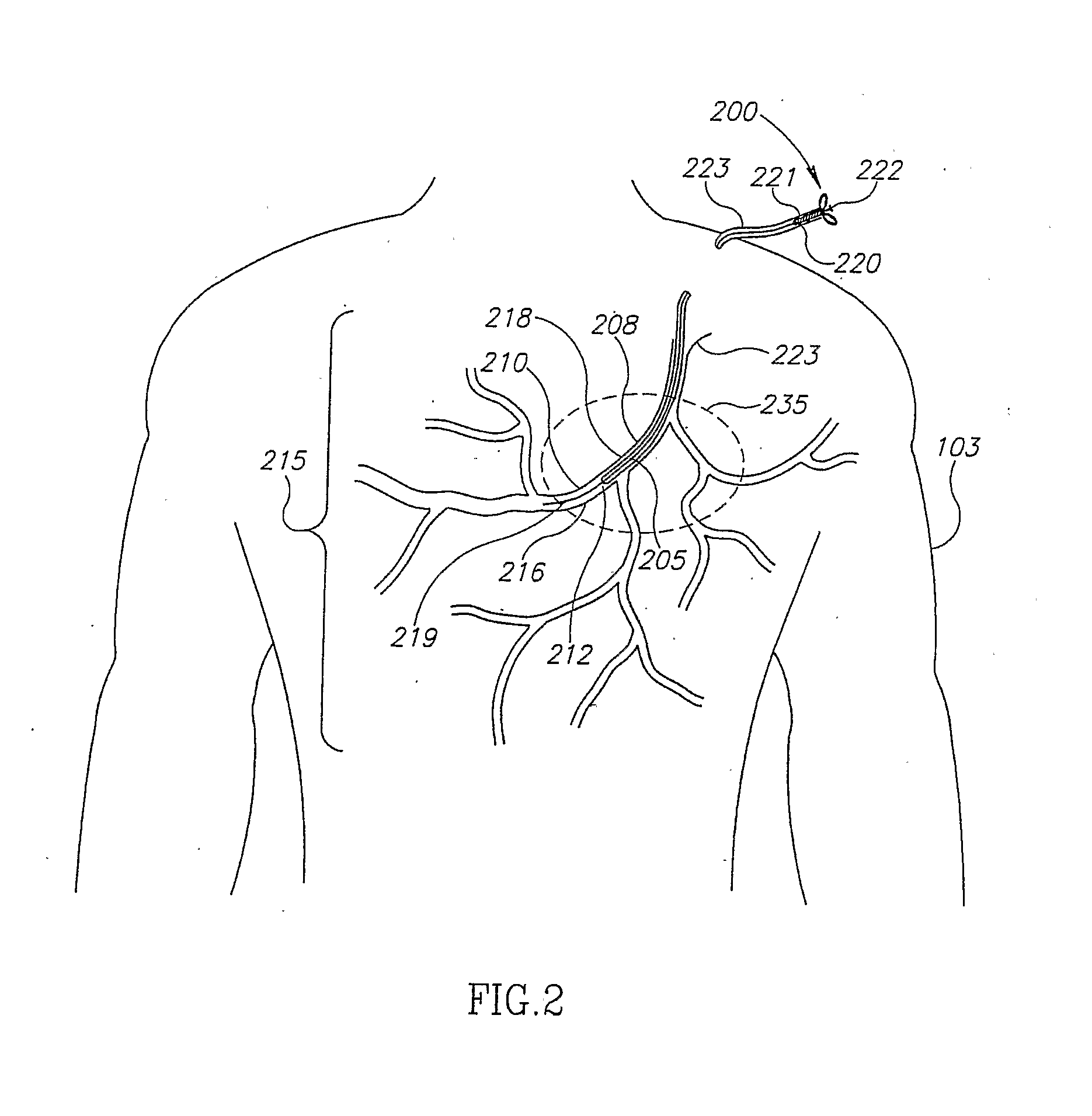 Method and apparatus for guiding a device in a totally occluded or partly occluded tubular organ