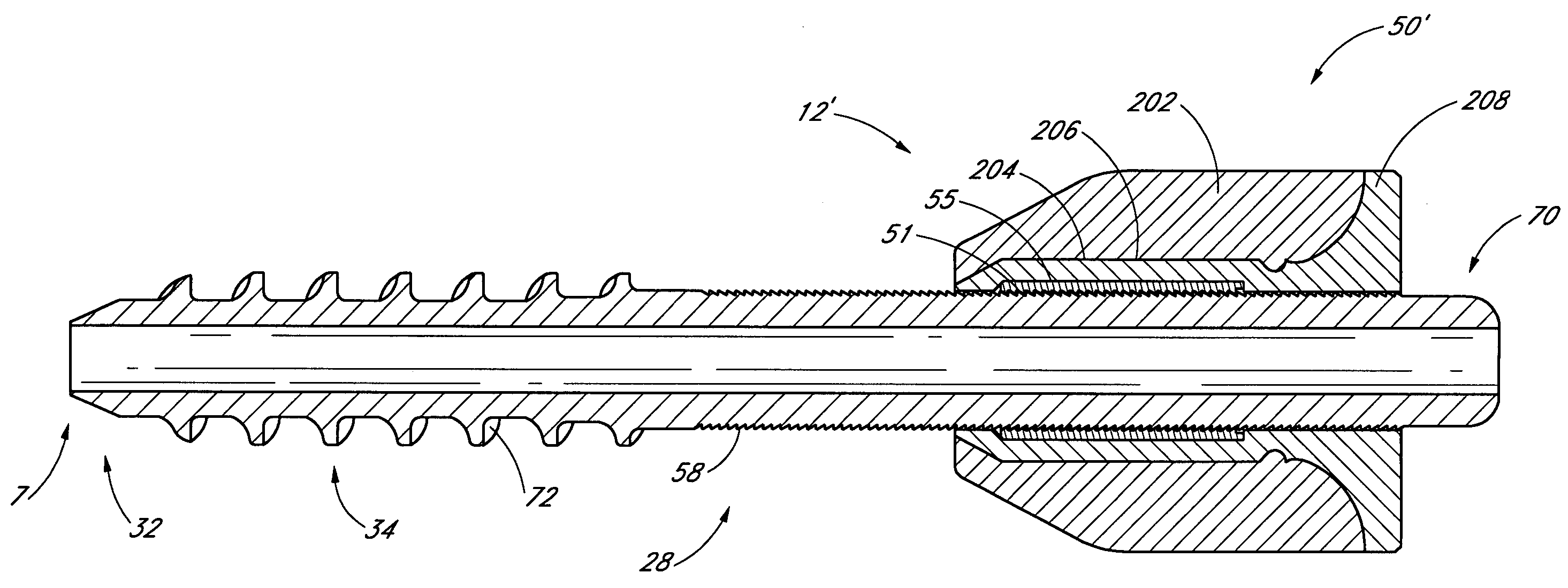 Method and apparatus for spinal stabilization