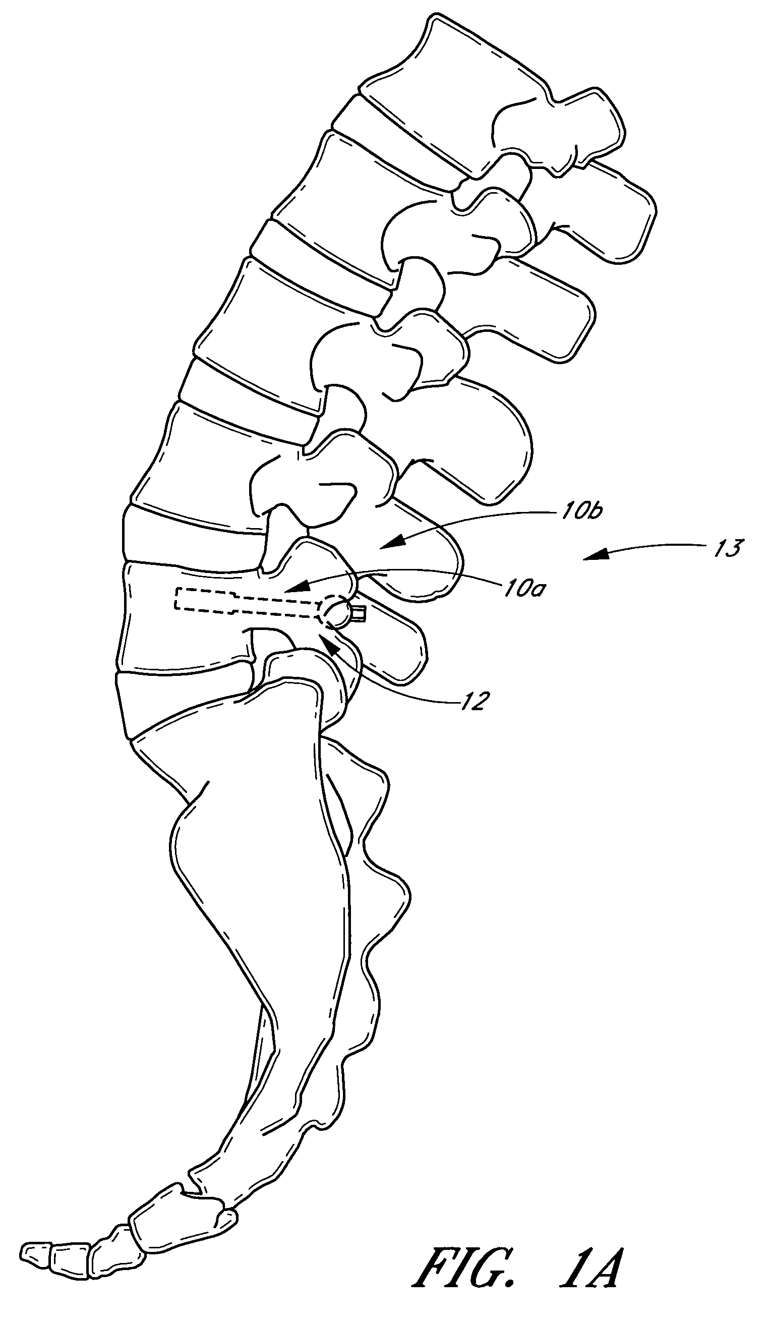 Method and apparatus for spinal stabilization