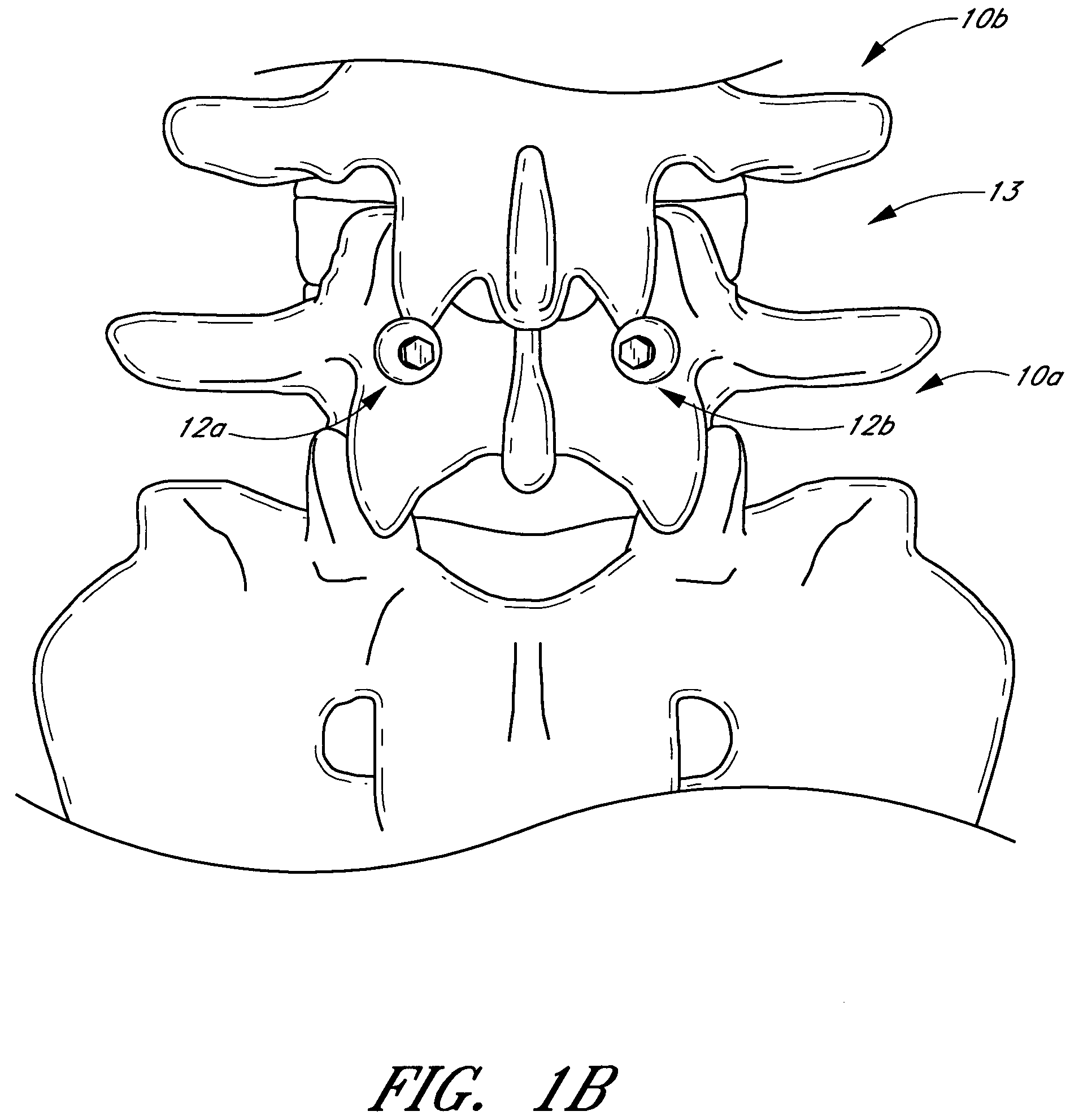 Method and apparatus for spinal stabilization