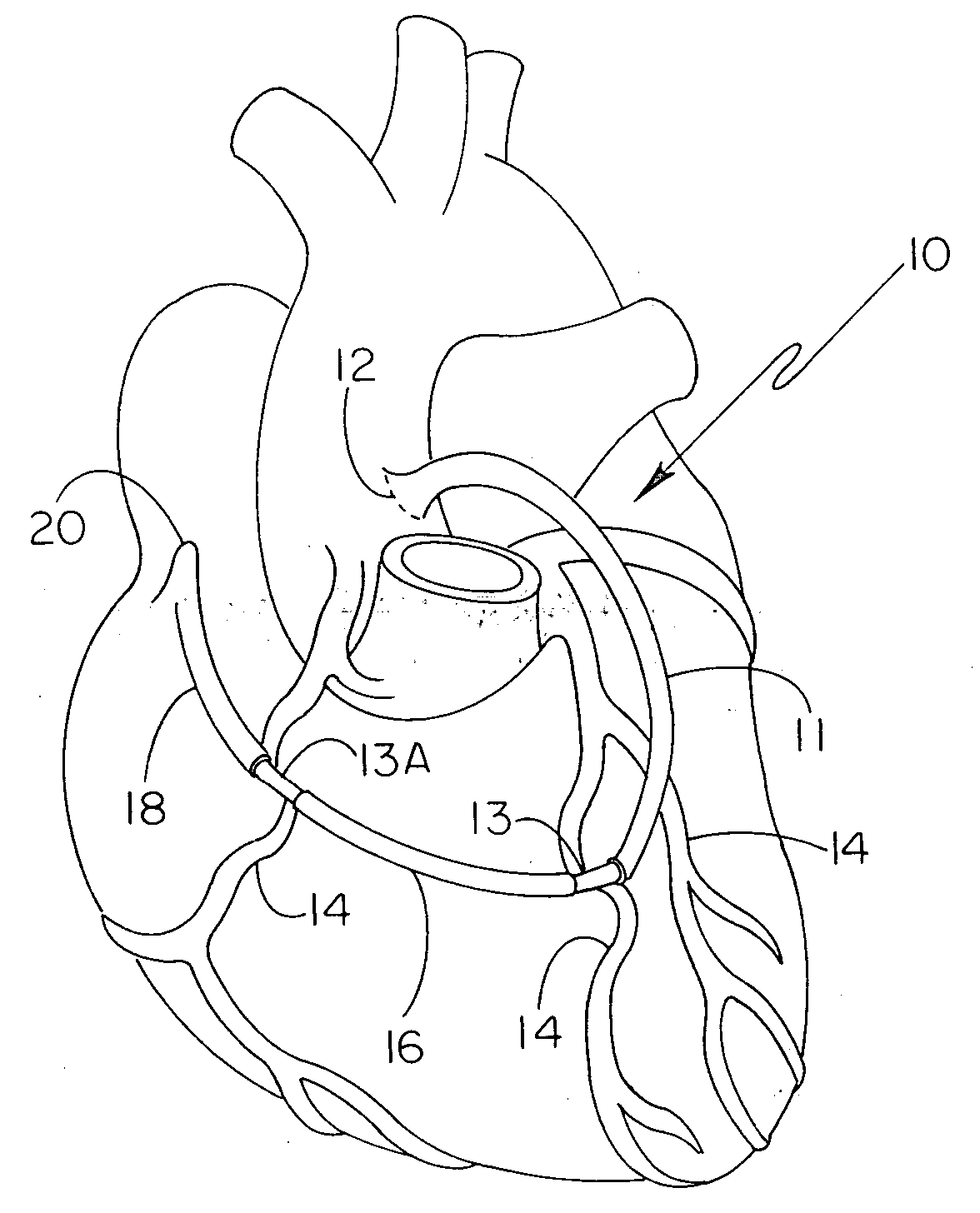 Grafted network incorporating a multiple channel fluid flow connector