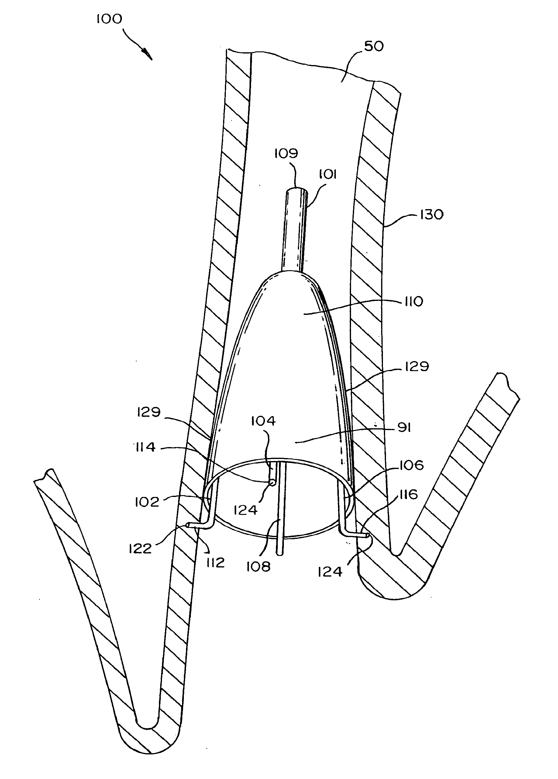 Removable anchored lung volume reduction devices and methods