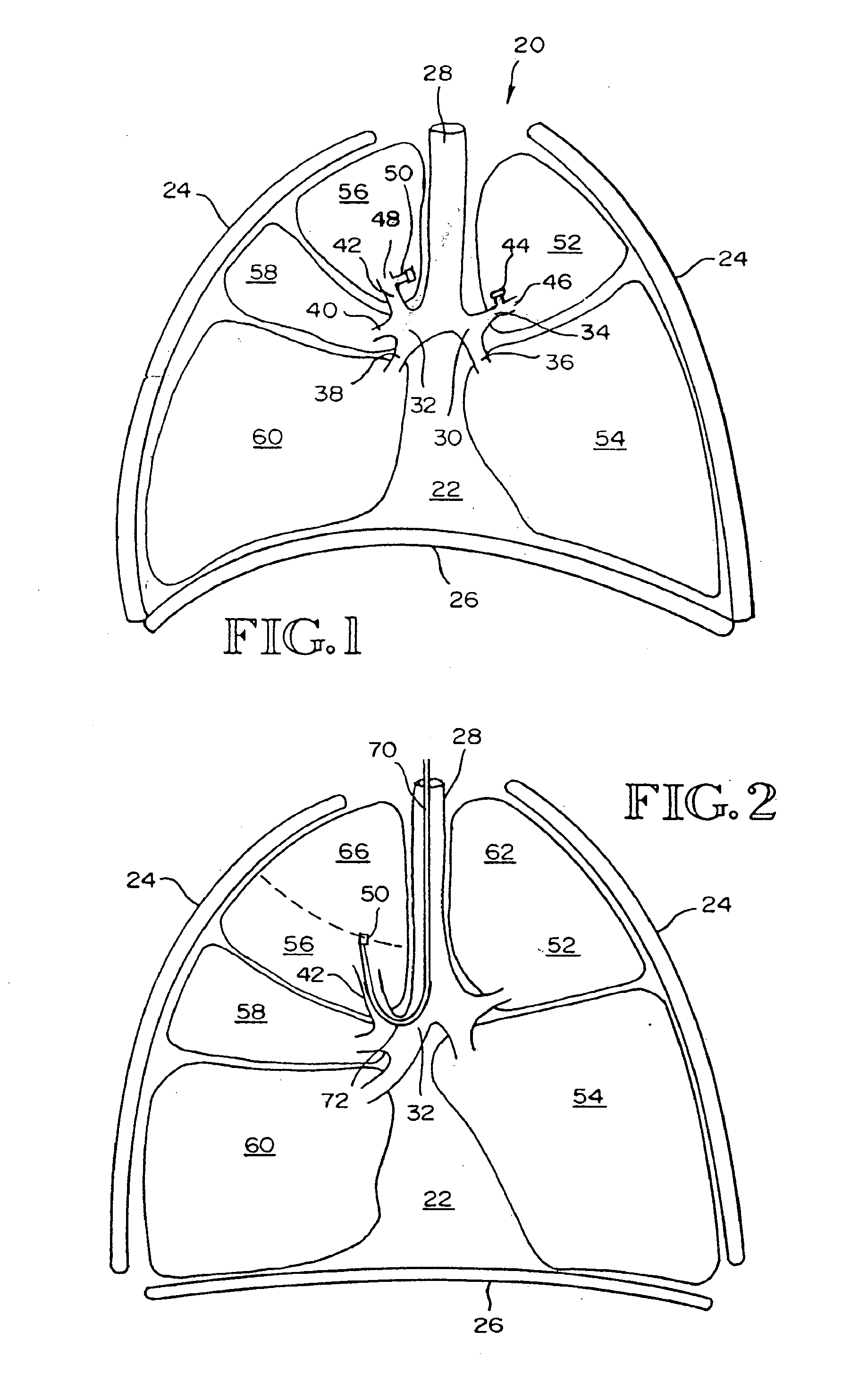 Removable anchored lung volume reduction devices and methods