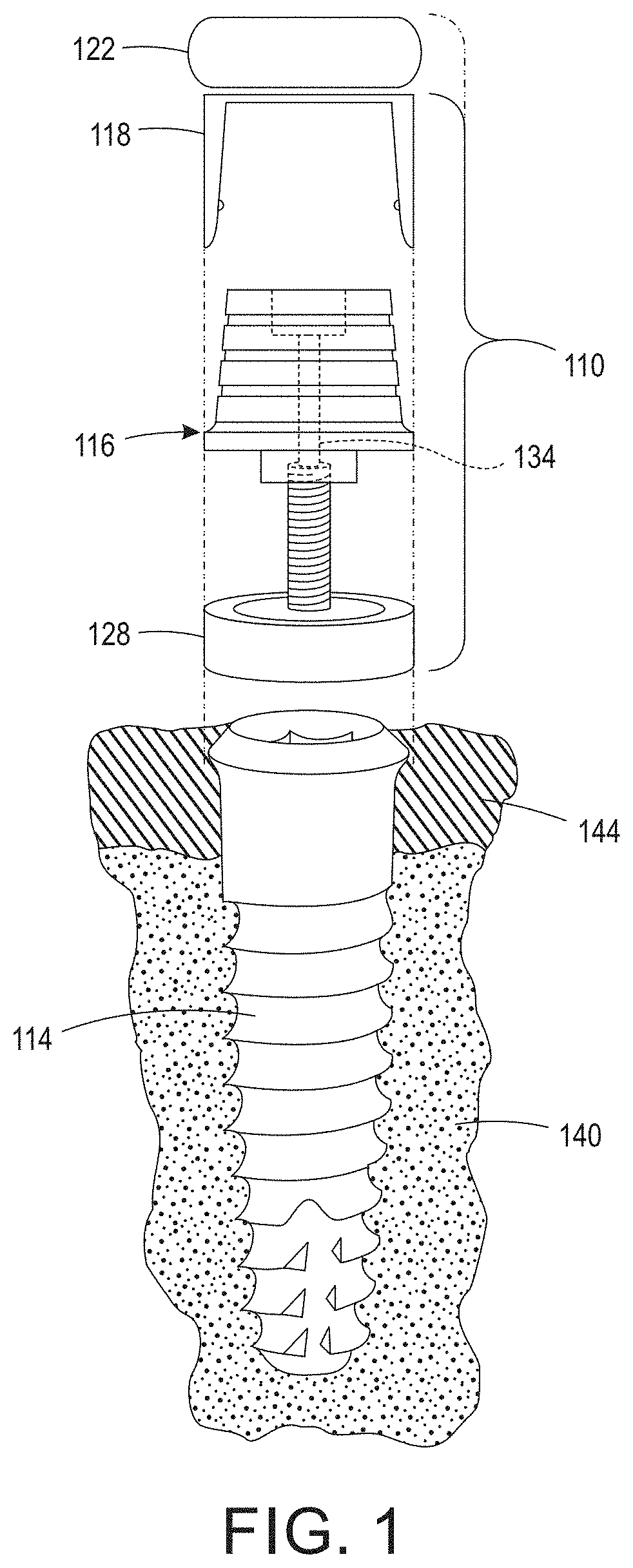 Digital full arch method for immediate definitive dental prostheses