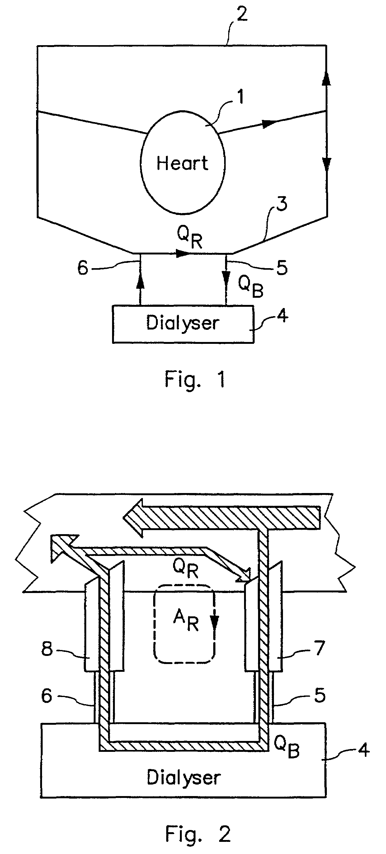 Device and a method for determining blood recirculation in a vascular access