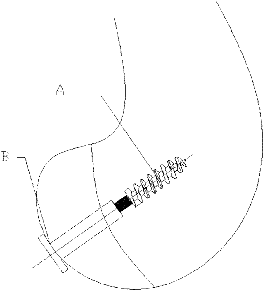 Screw applied to thighbone posterior condyle fractures